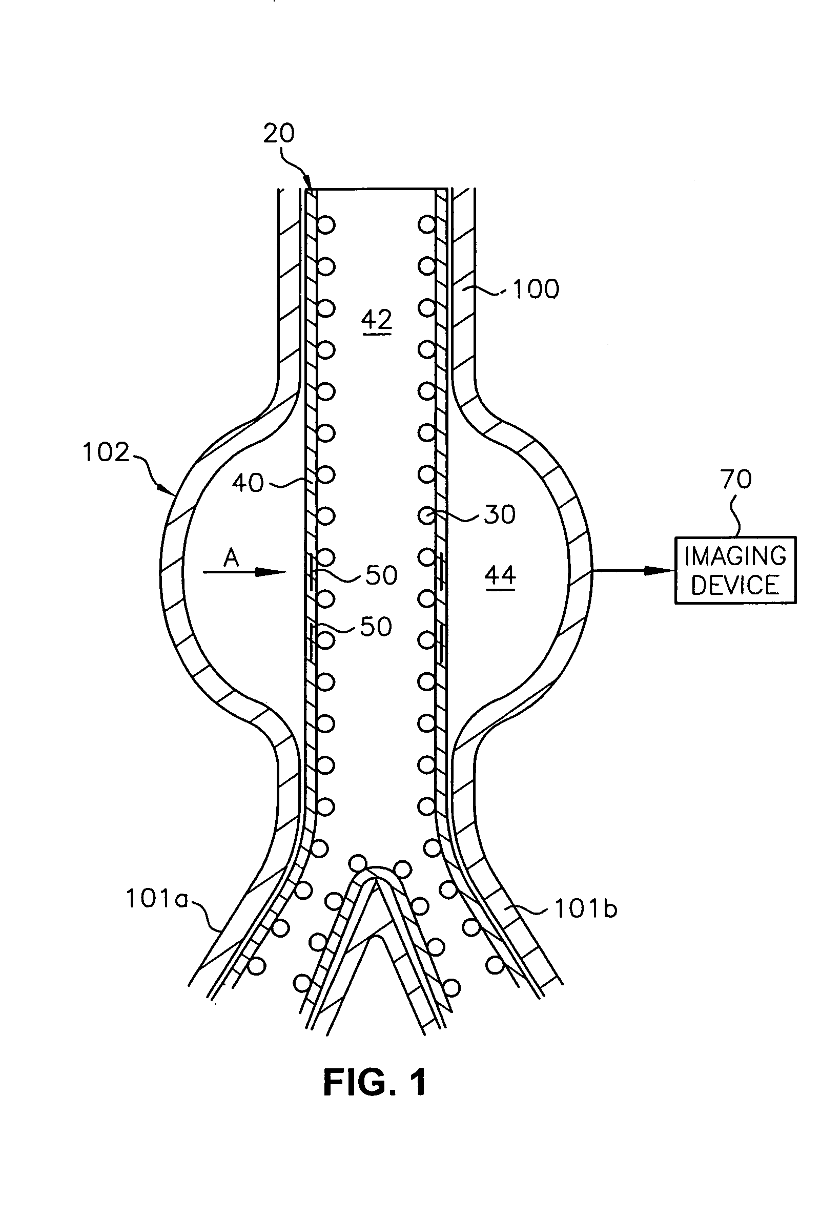 Endoluminal device and system and method for detecting a change in pressure differential across an endoluminal device