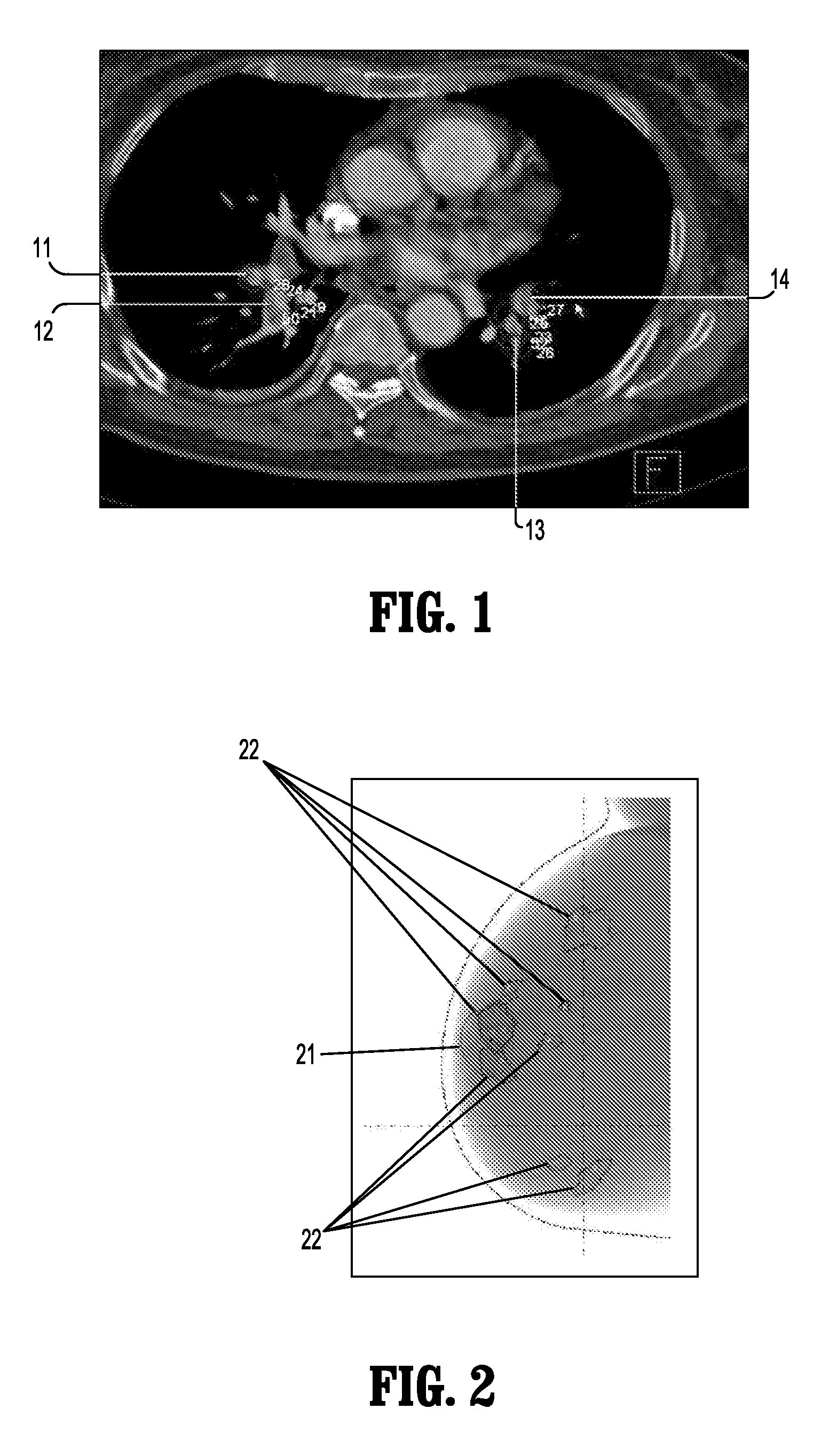 System and Method for Multiple-Instance Learning for Computer Aided Diagnosis