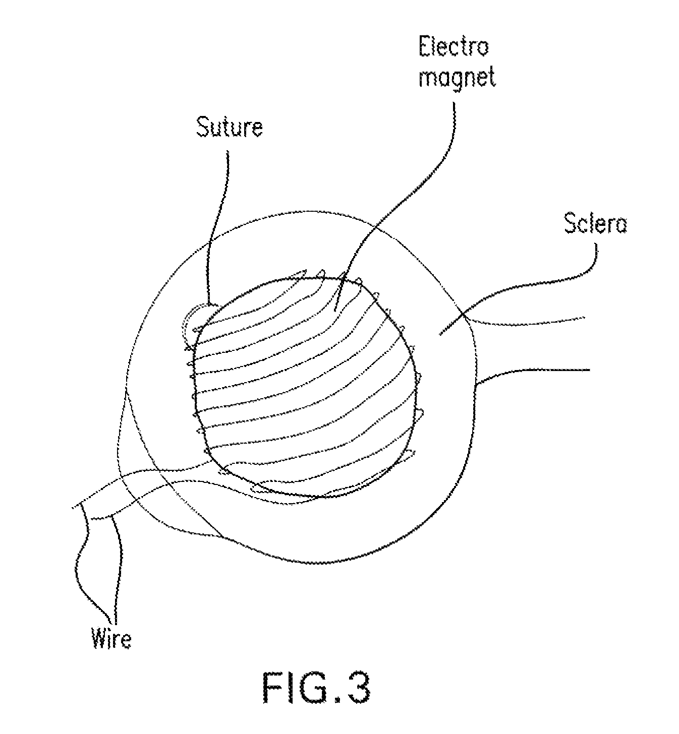 Method and composition for hyperthermally treating cells