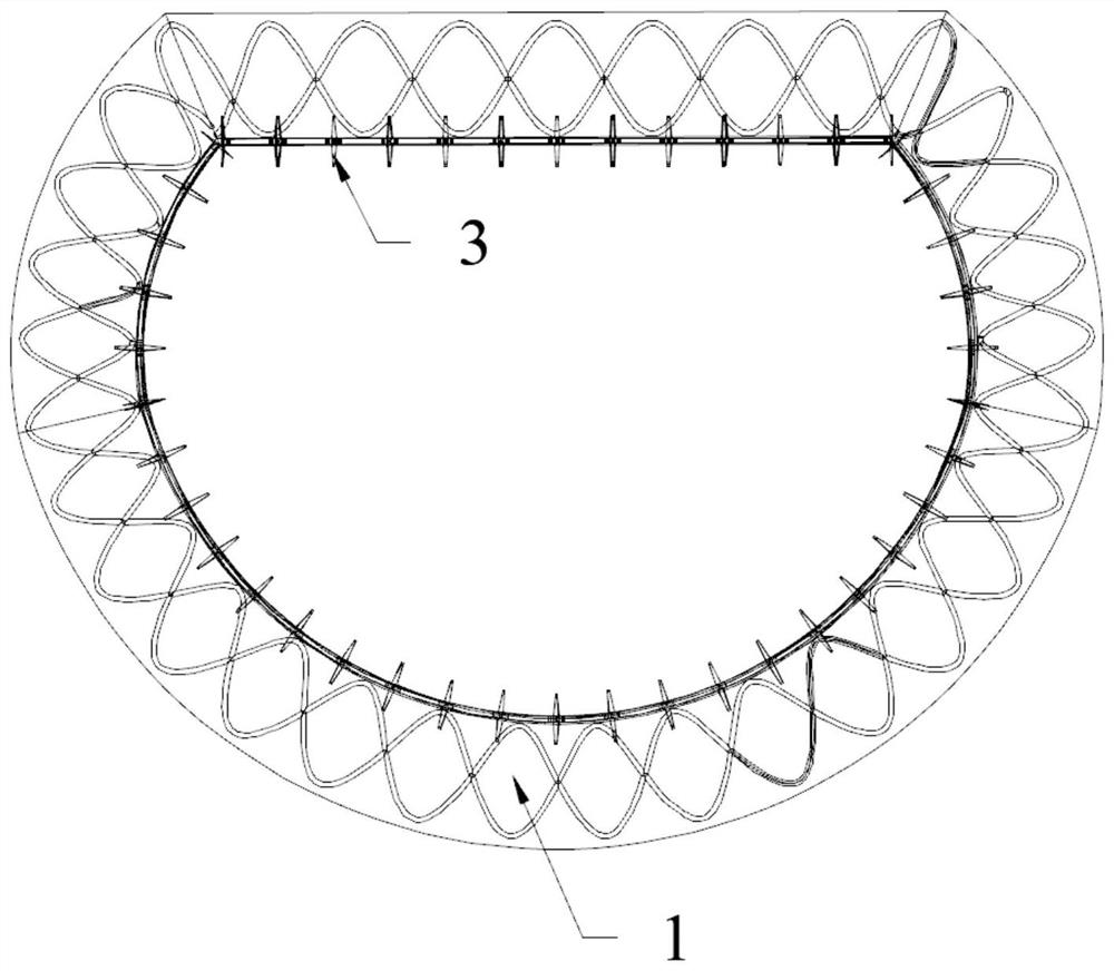 Mitral valve forming ring for intervention