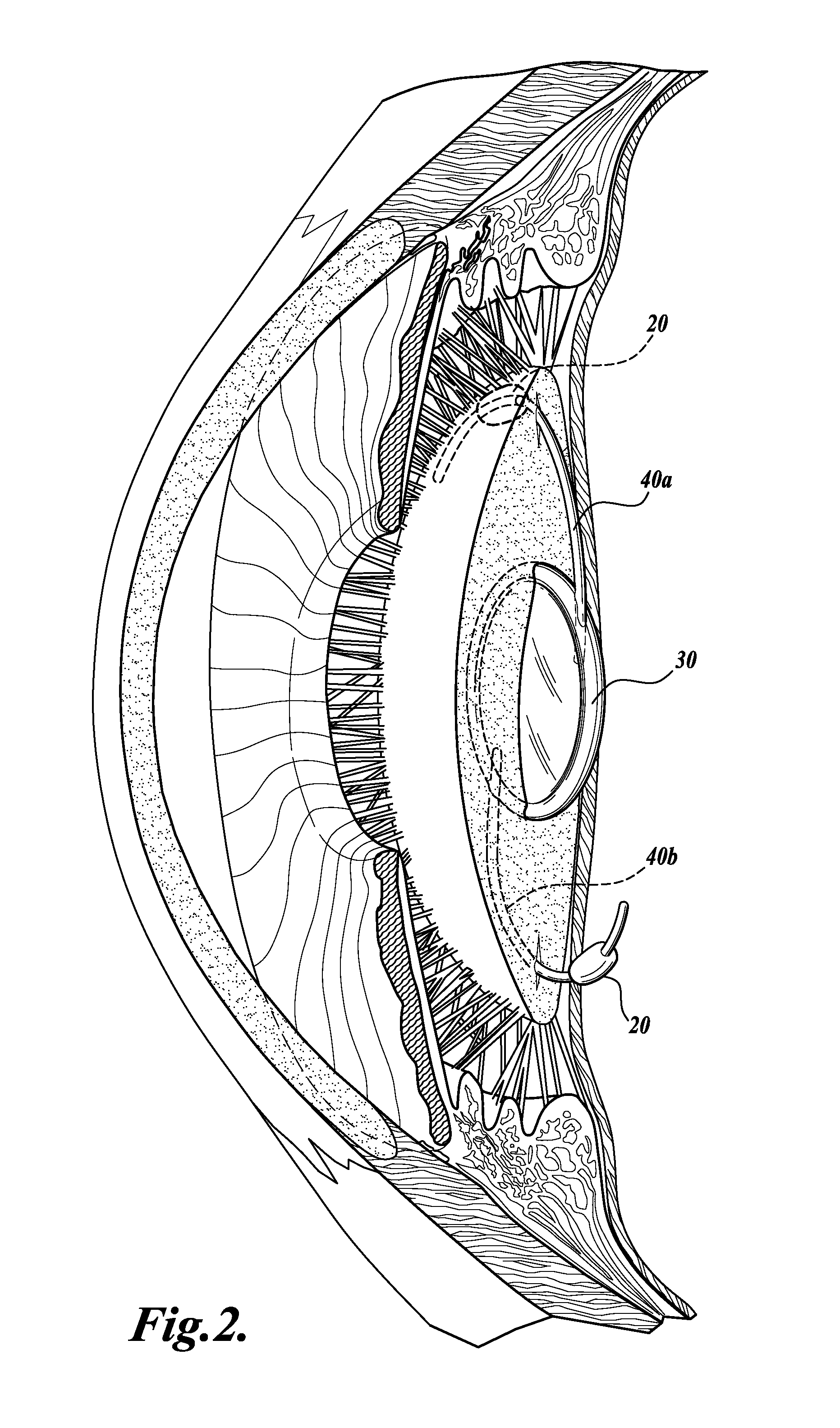 Device and method for intraocular drug delivery