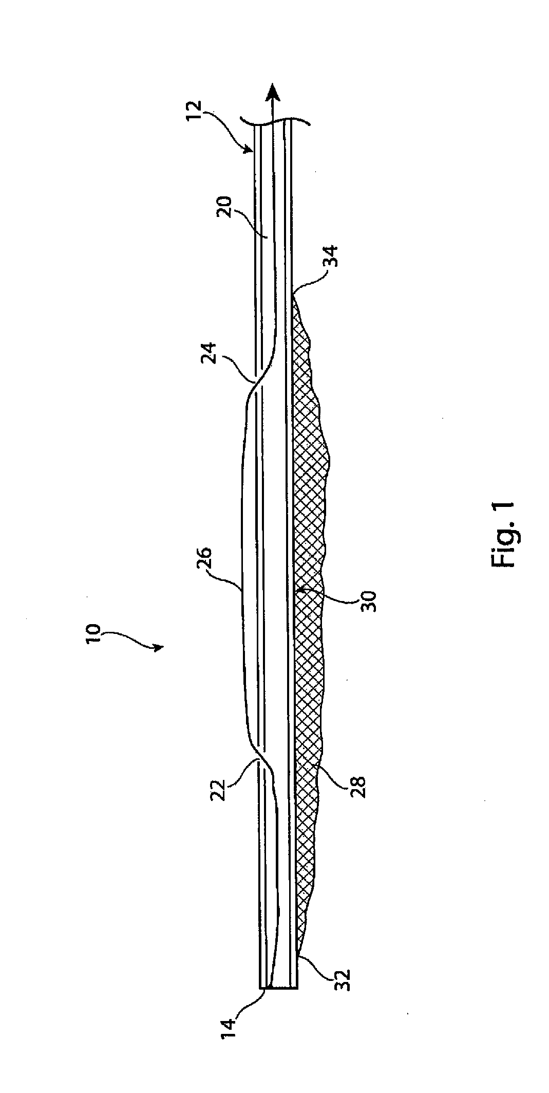 Obstruction capture and removal device