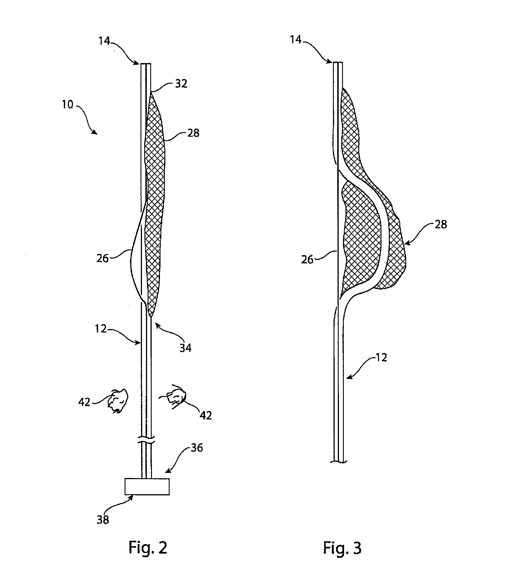 Obstruction capture and removal device