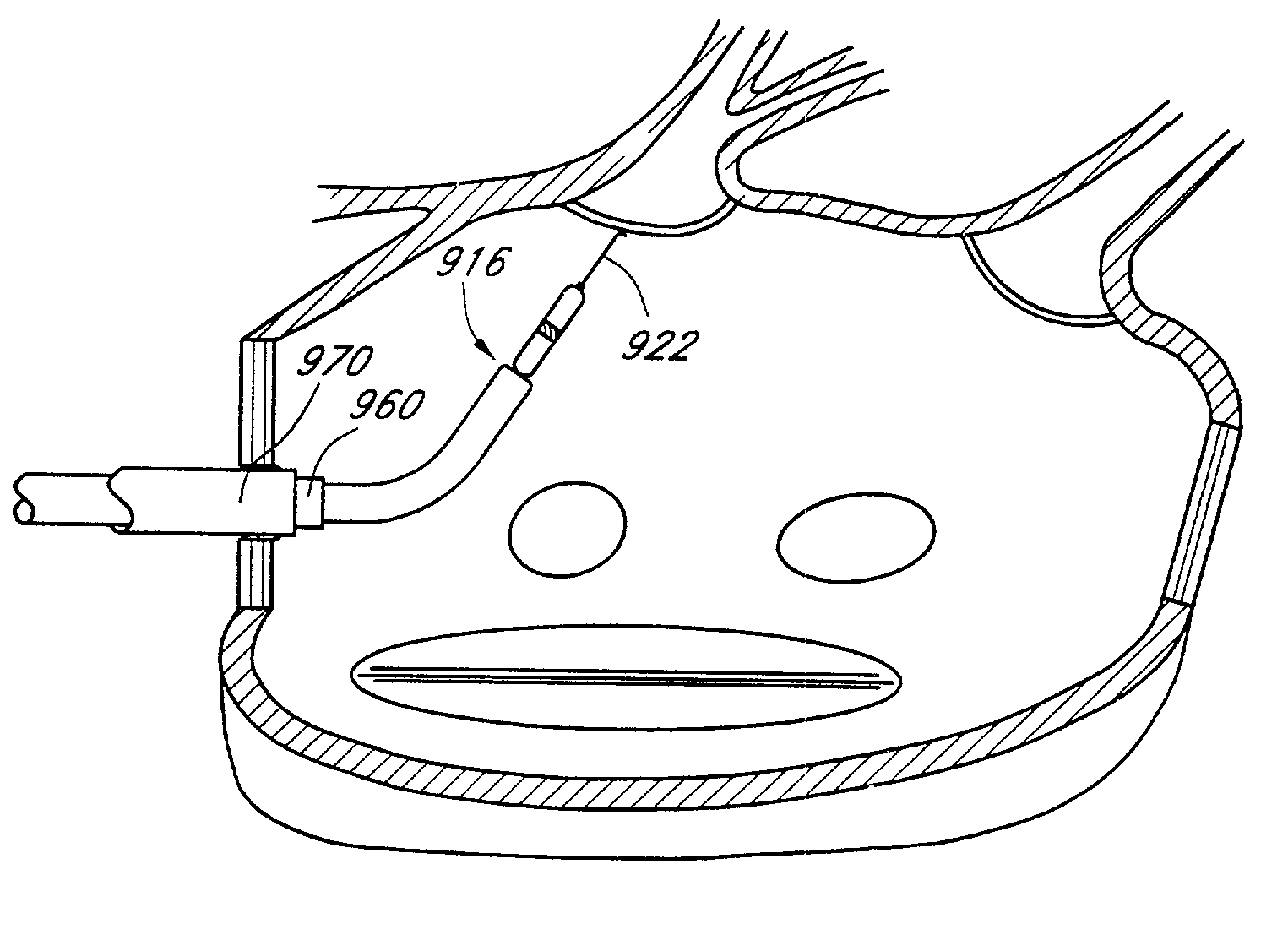 Deflectable tip catheter with guidewire tracking mechanism