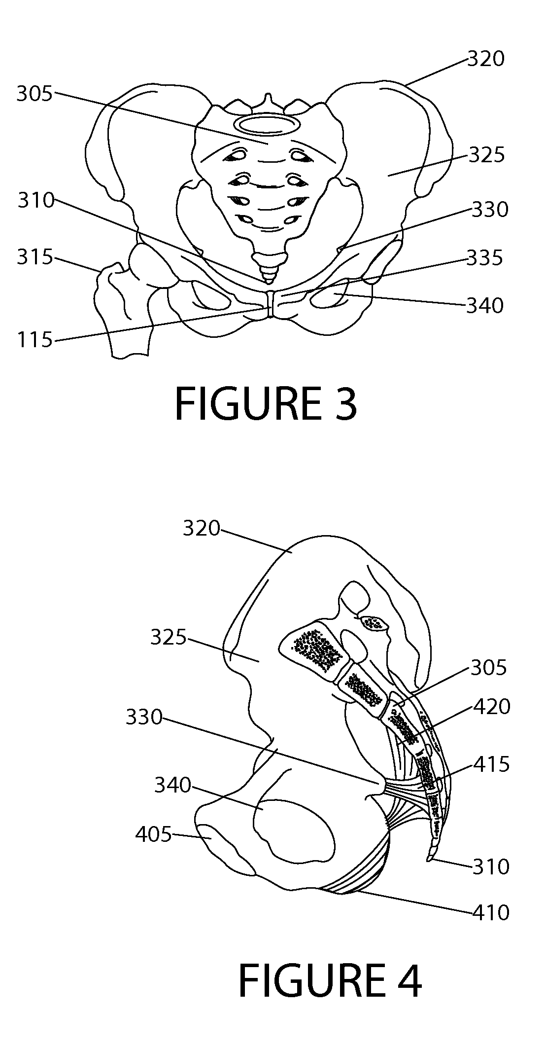 Surgical devices and method for vaginal prolapse repair