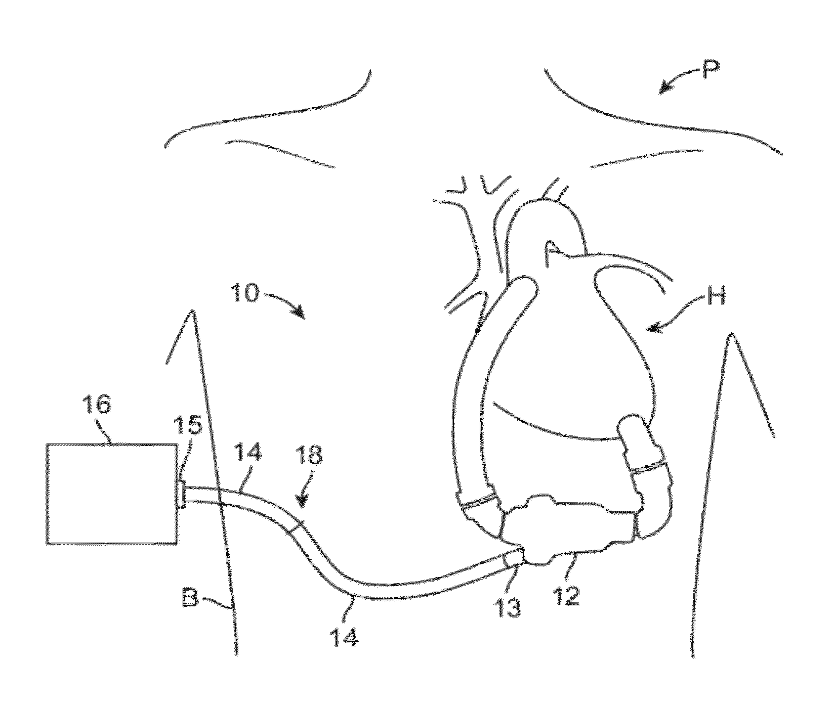Assembly and method for stabilizing a percutaneous cable