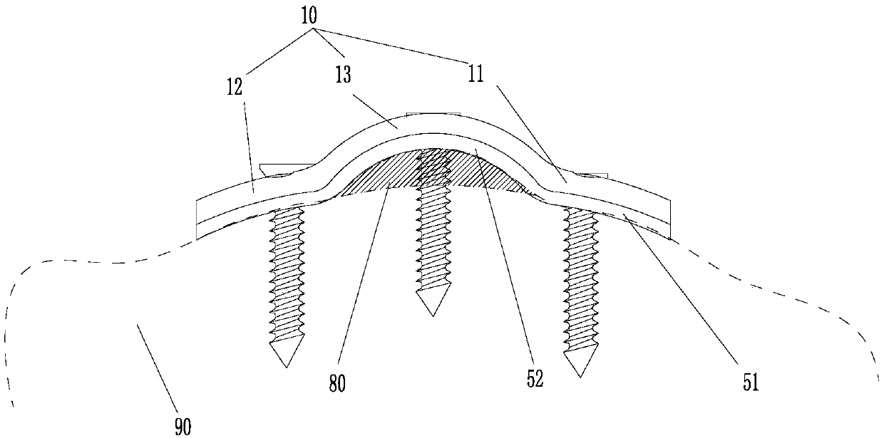 Patellar tendon attaching device