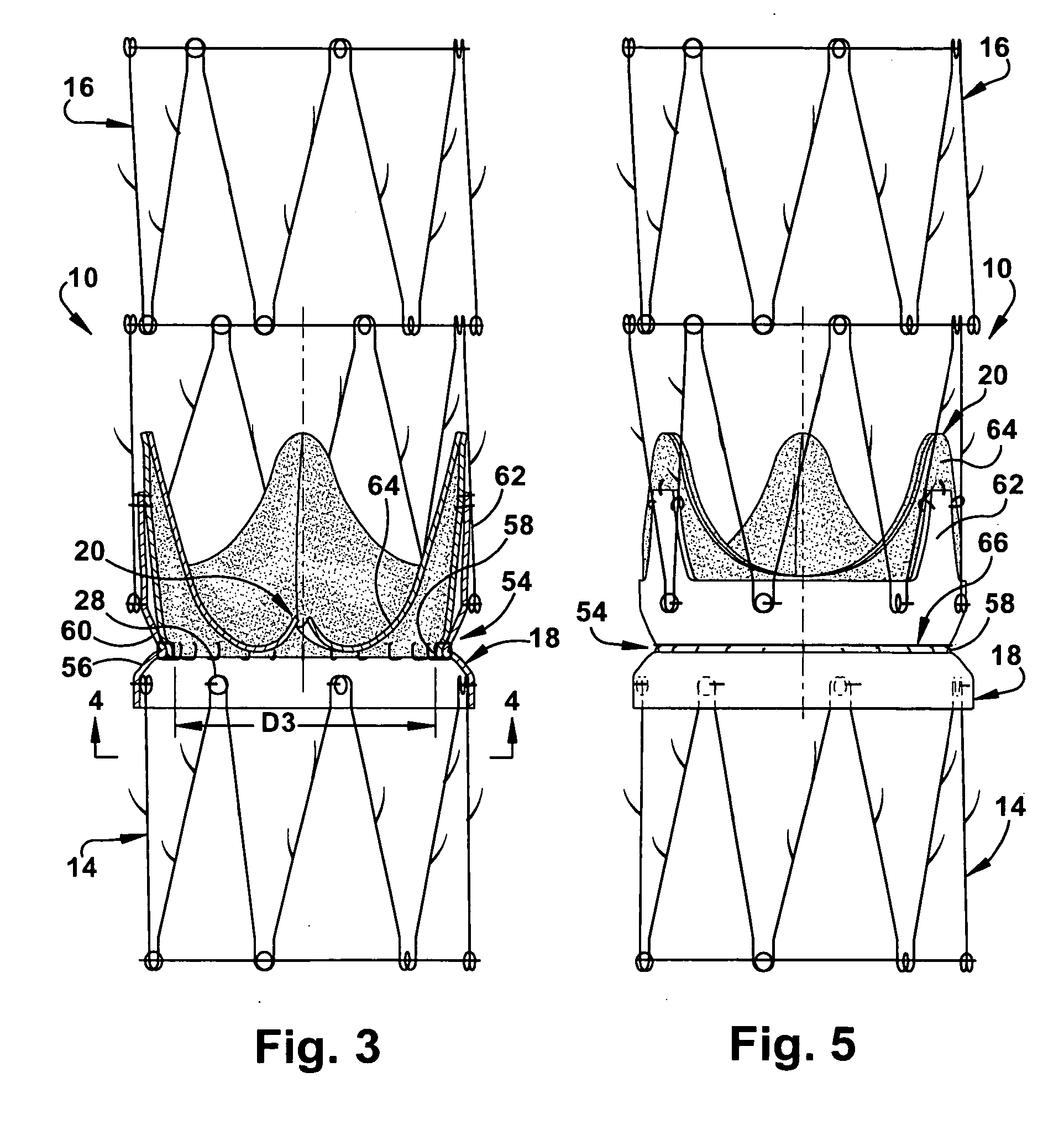 Apparatus and methods for repairing the function of a diseased valve and method for making same