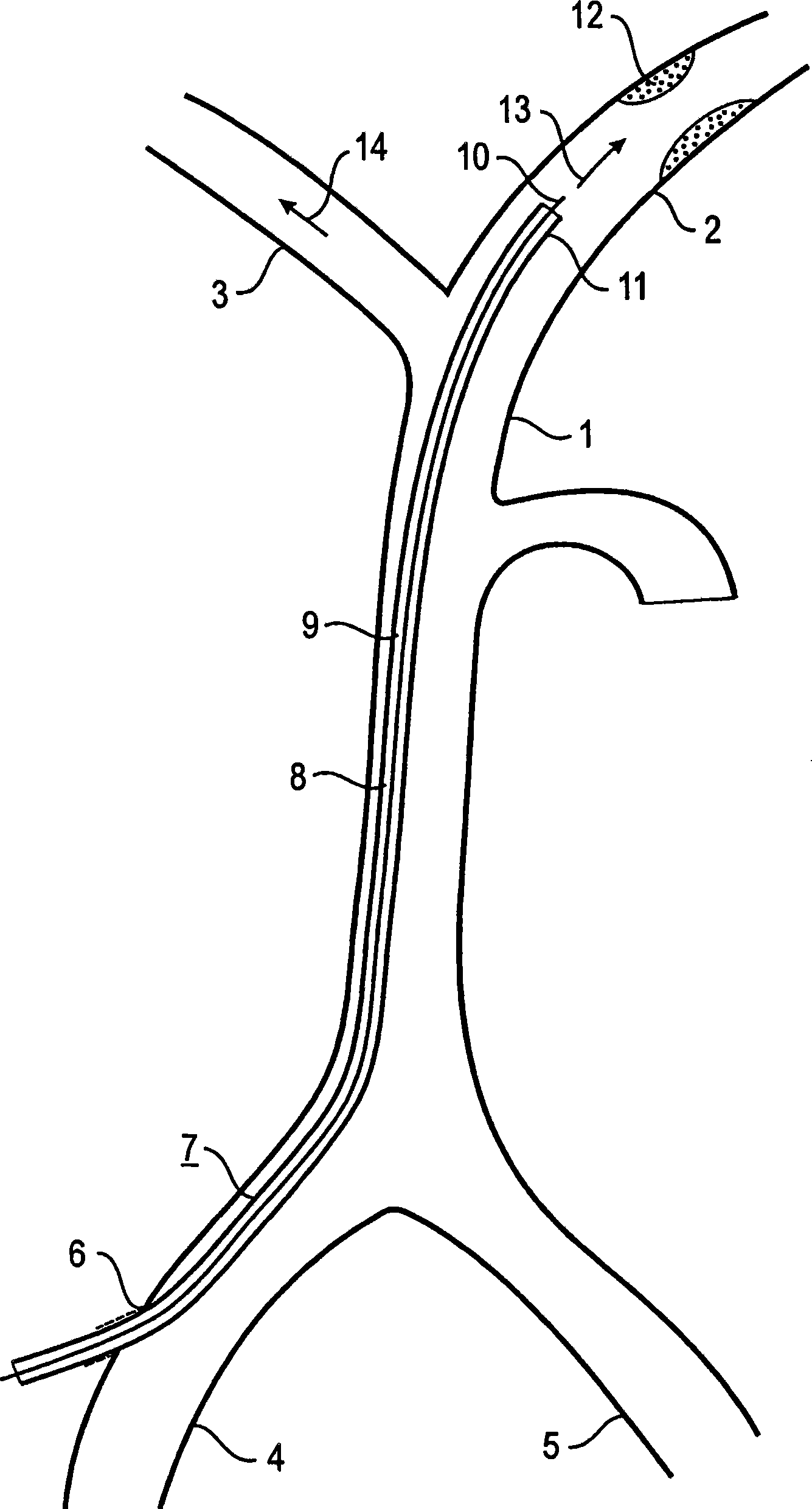 Device and method for reducing or removing stenoses