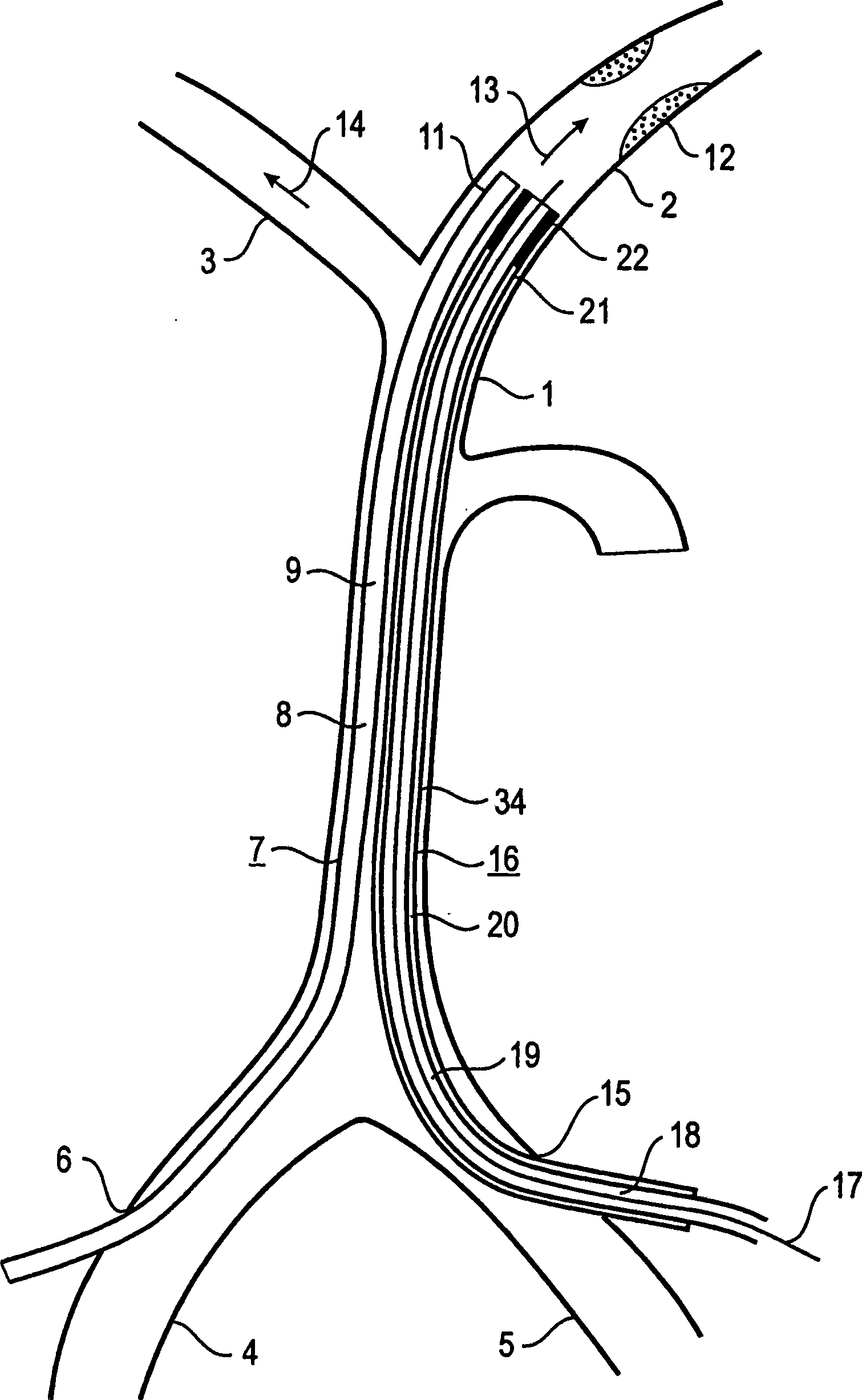 Device and method for reducing or removing stenoses
