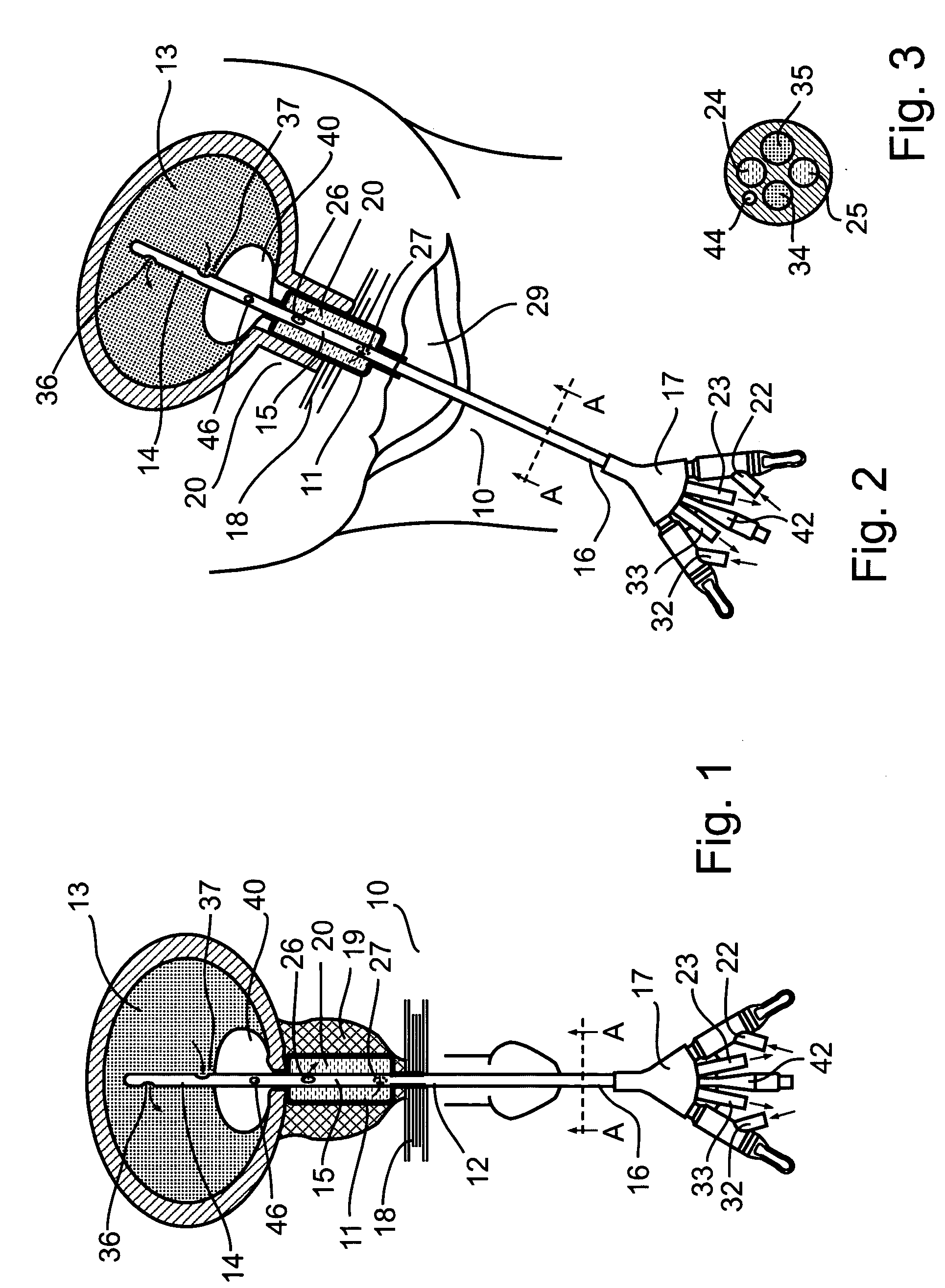 System and method for treating urinary tract disorders