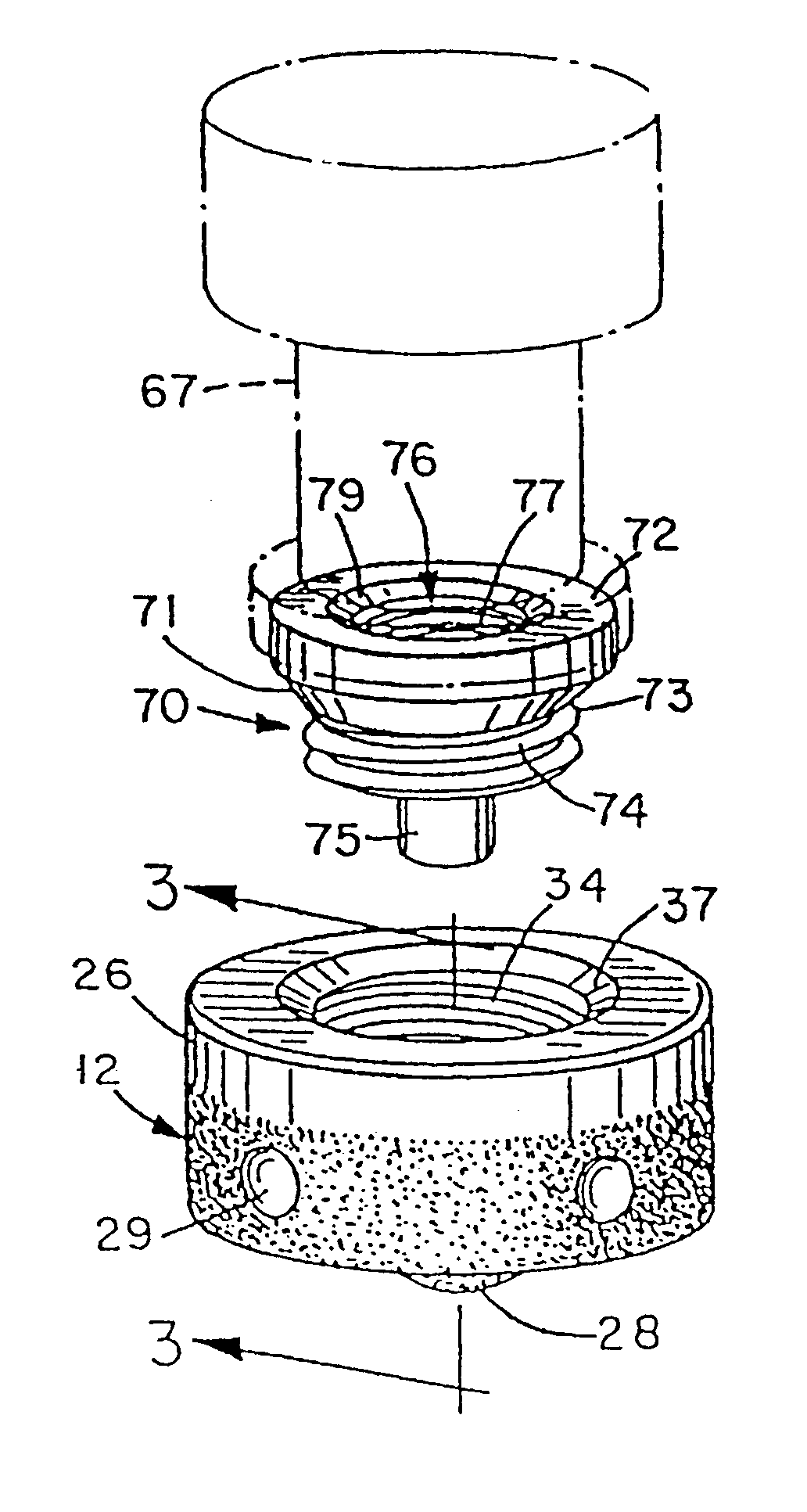 Dental implant system