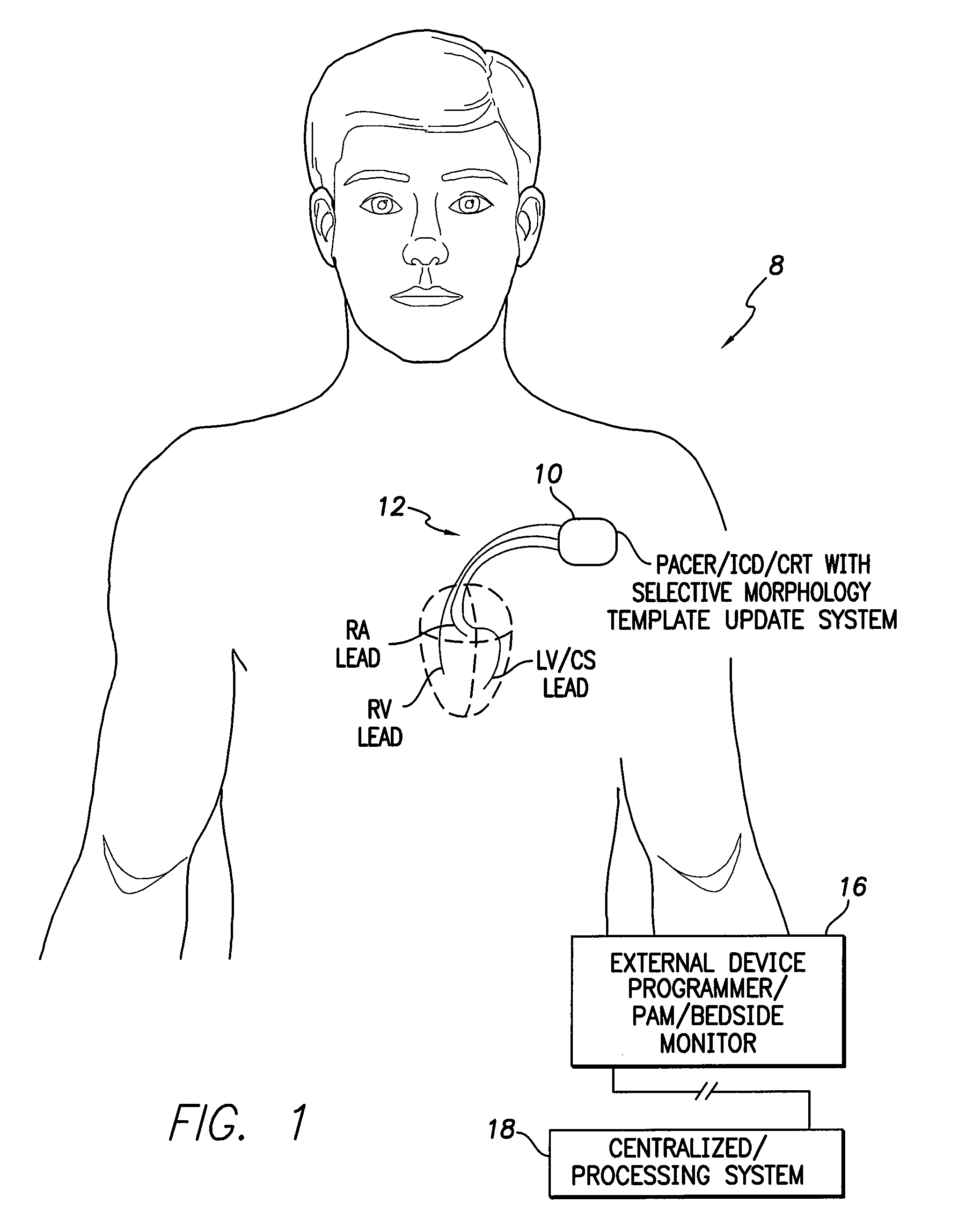 Systems and methods for selectively updating cardiac morphology discrimination templates for use with implantable medical devices