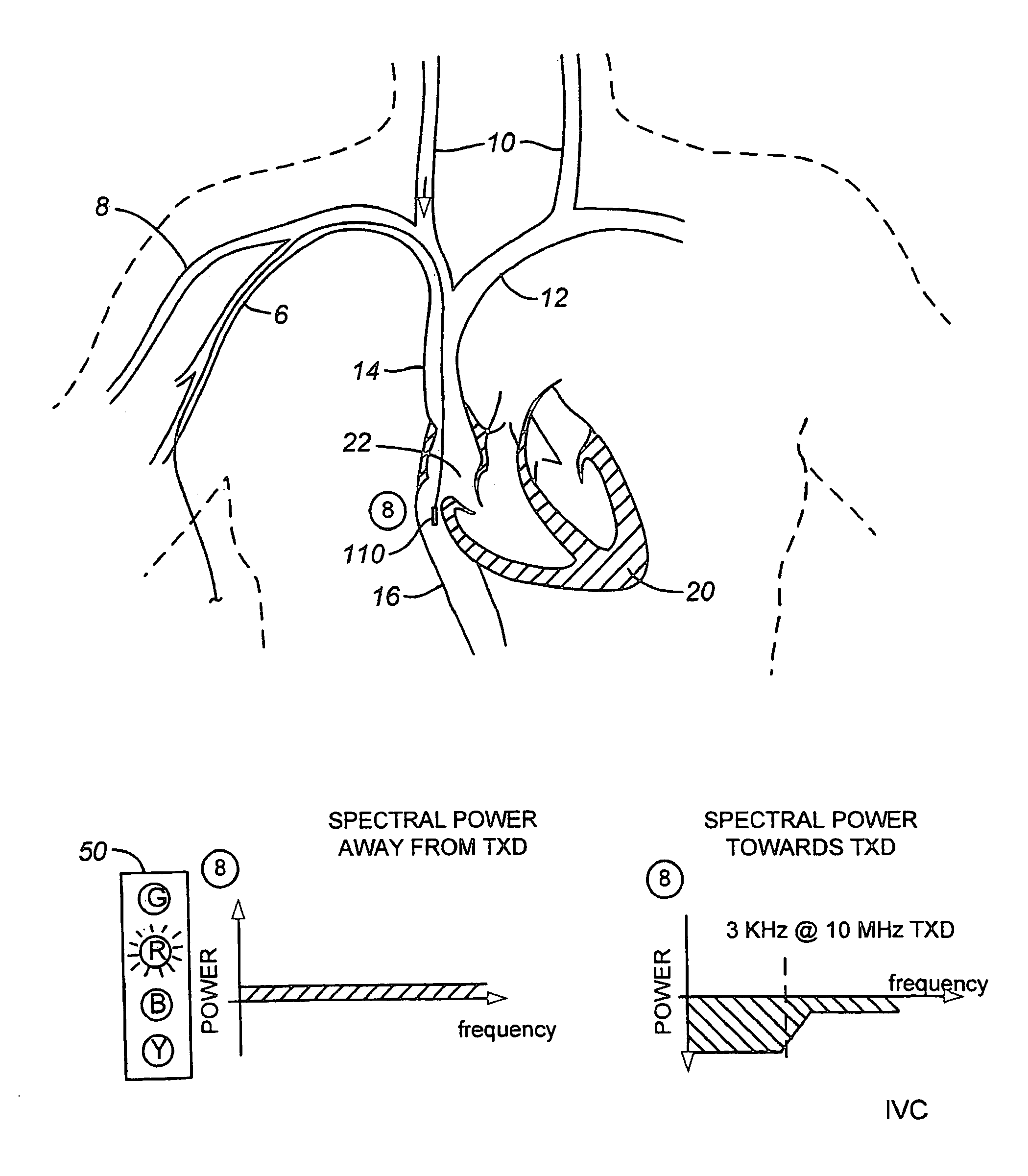 Ultrasound methods of positioning guided vascular access devices in the venous system