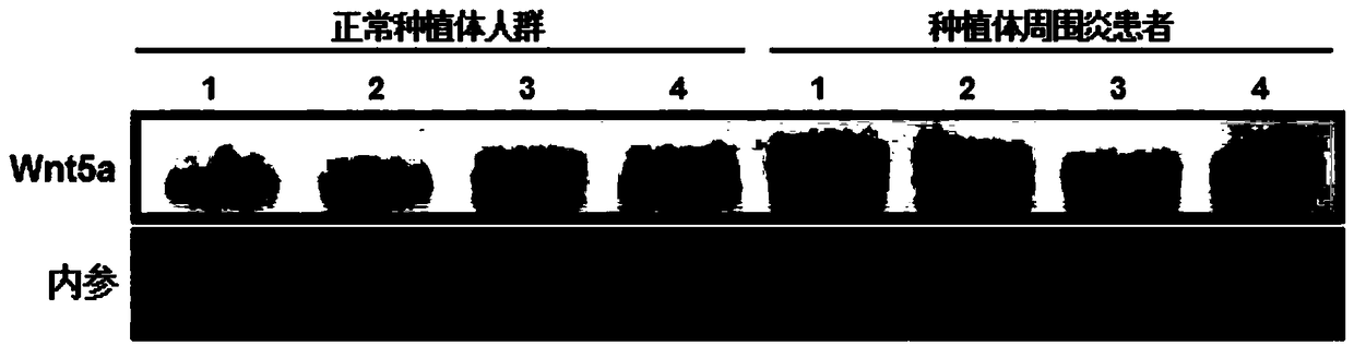 Application of Wnt5a as diagnosis marker of peri-implantitis