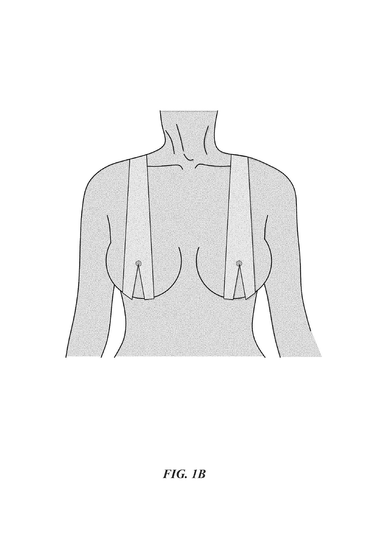 Hydrocolloid dressing for precise nipple positioning after nipple- or skin-sparing mastectomy