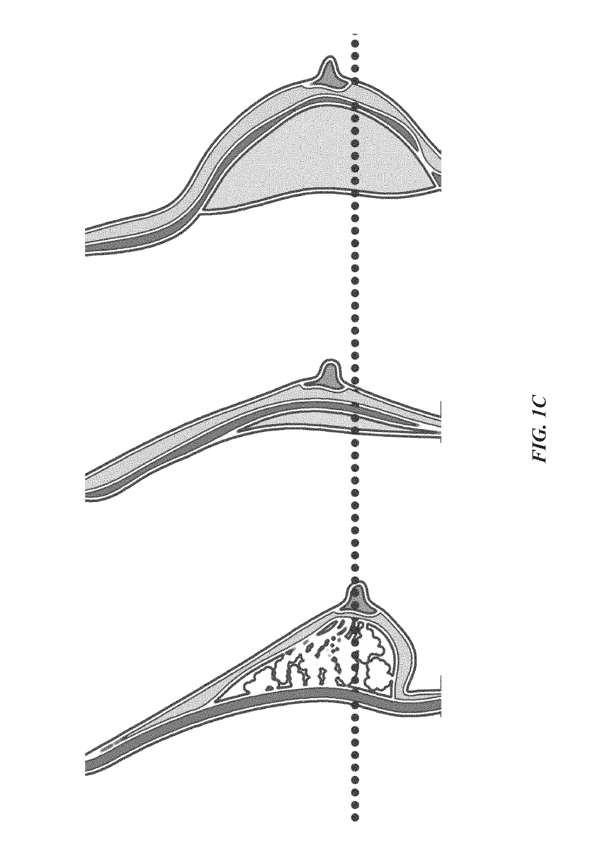 Hydrocolloid dressing for precise nipple positioning after nipple- or skin-sparing mastectomy