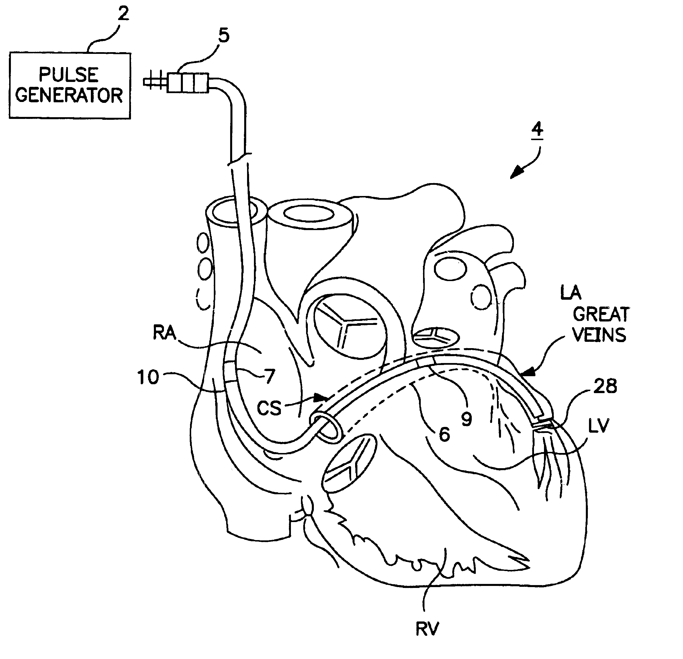 System and method for positioning an implantable medical device within a body