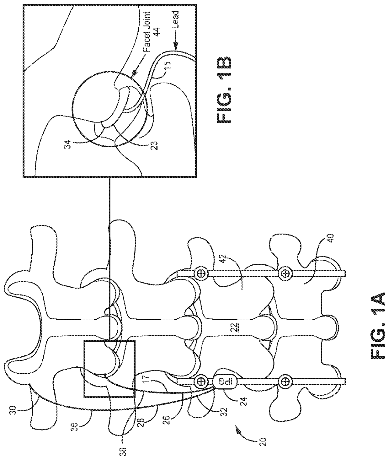 Systems, devices and methods for placement and fixation of neuromodulation system in combination with a laminectomy procedure