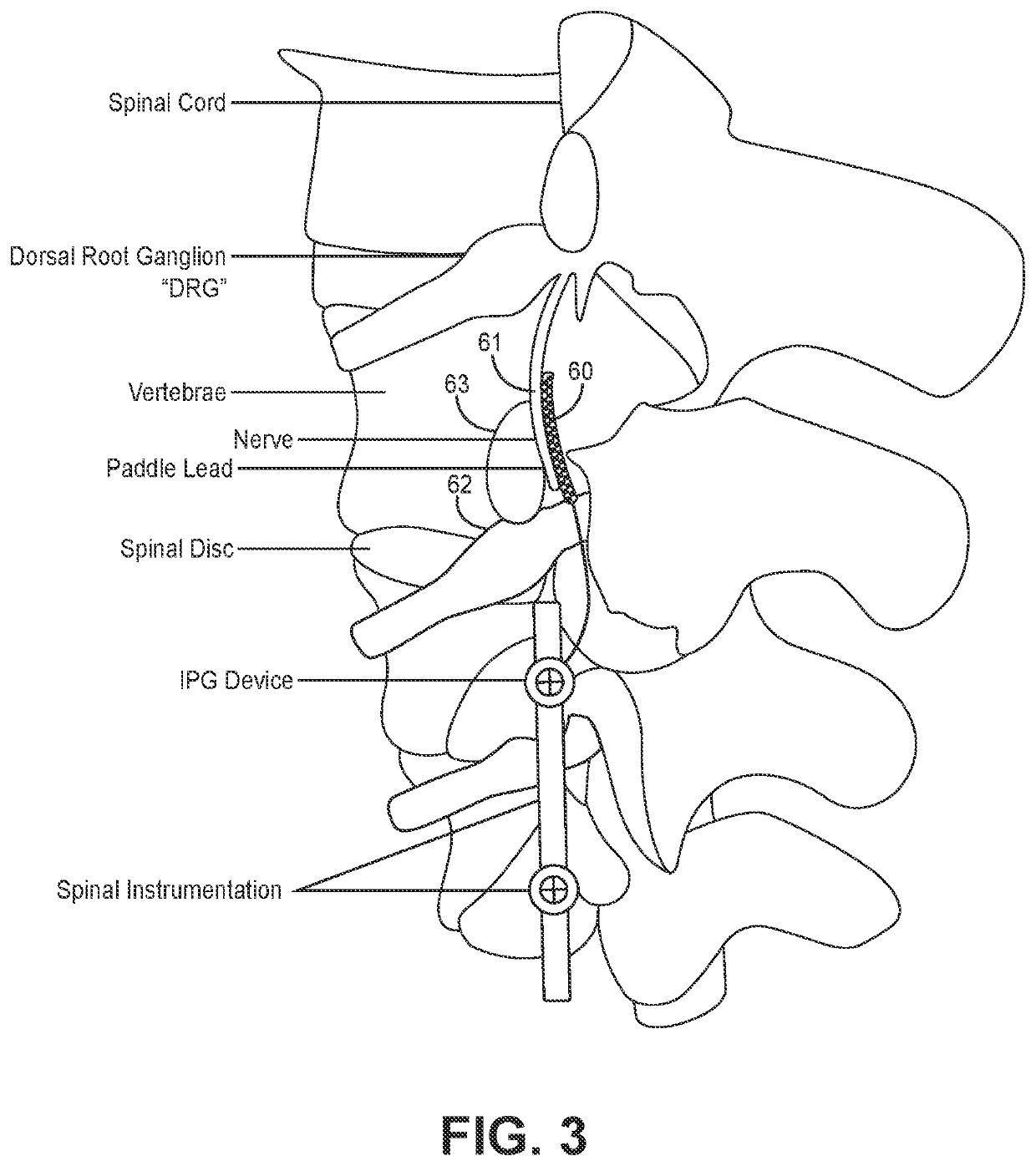 Systems, devices and methods for placement and fixation of neuromodulation system in combination with a laminectomy procedure