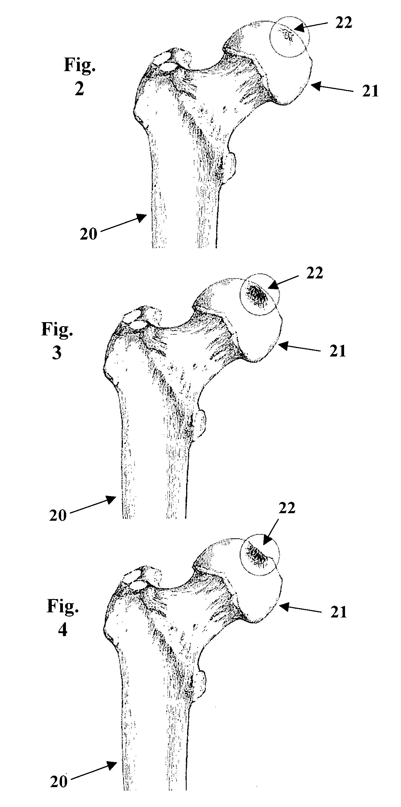 Method and composition for treating osteonecrosis and/or avascular necrosis