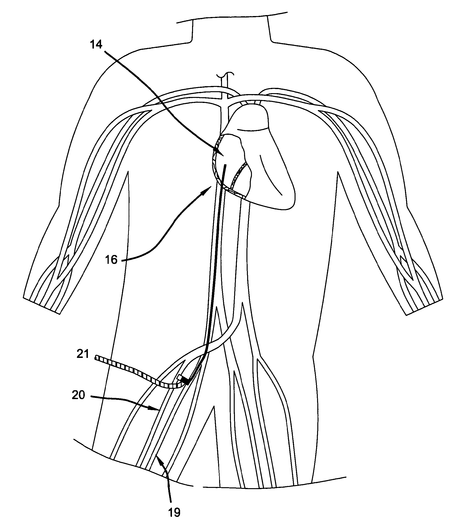 Hybrid arteriovenous shunt