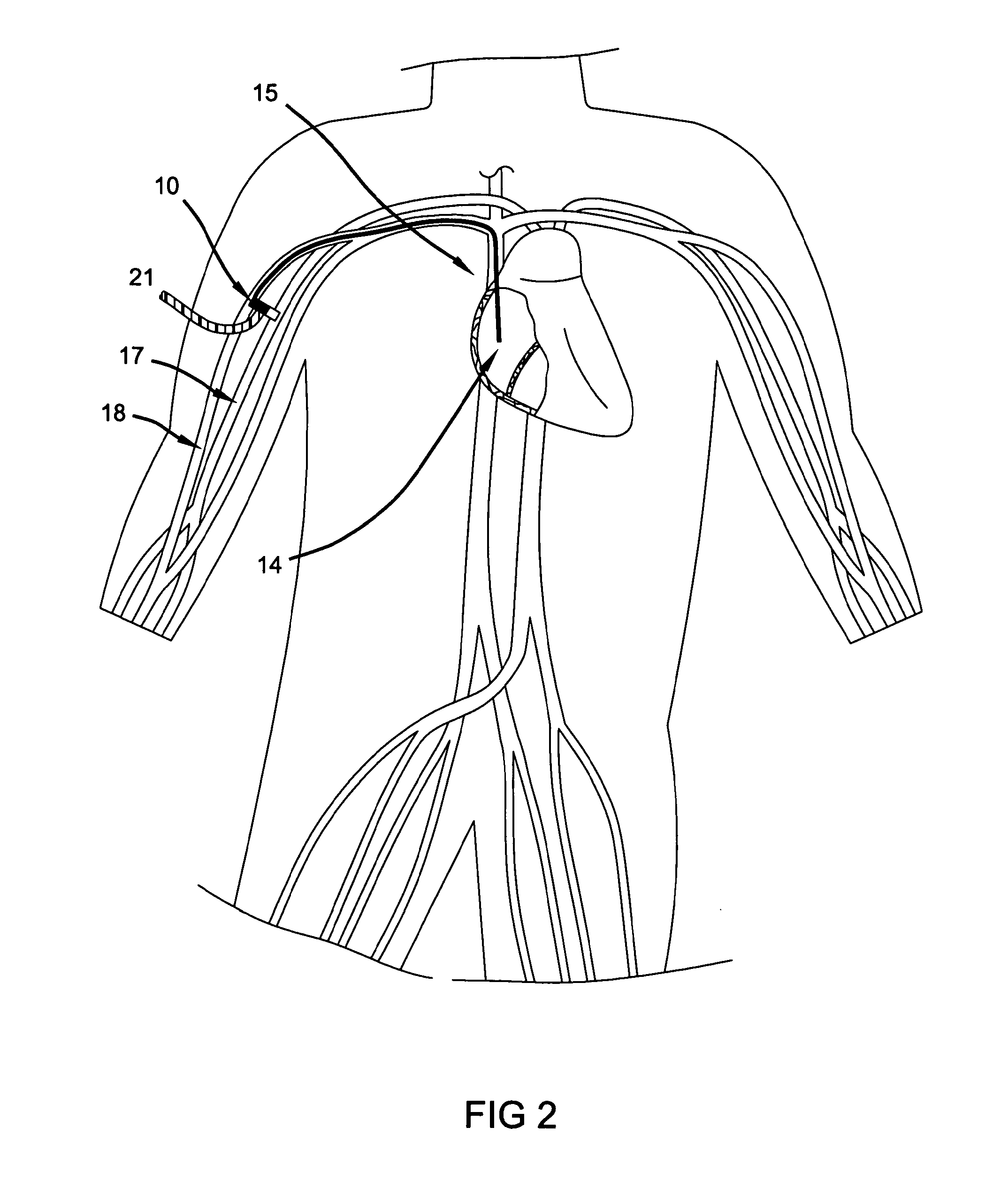 Hybrid arteriovenous shunt