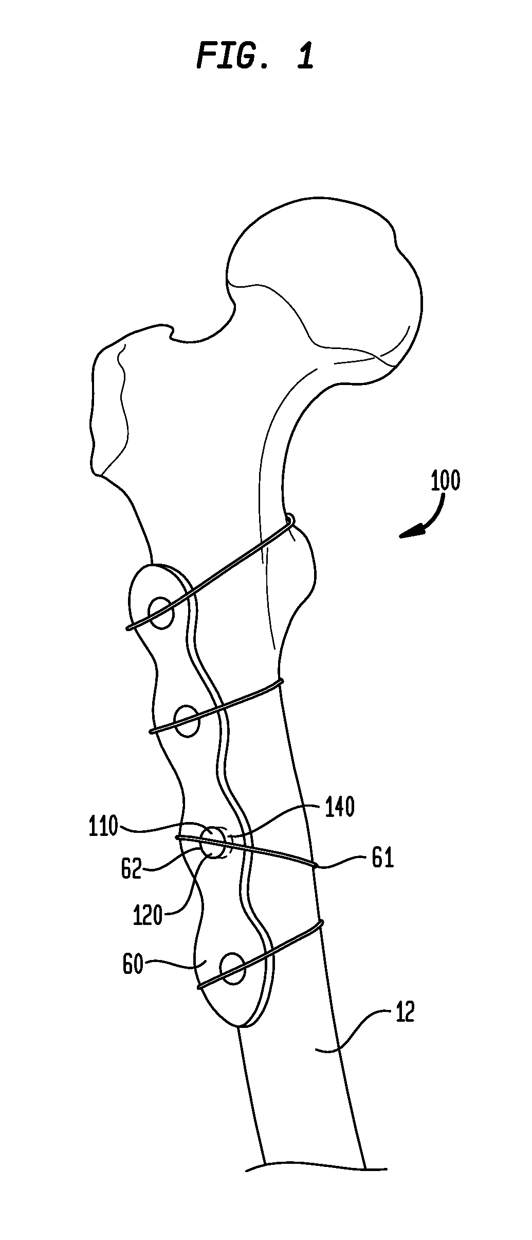 Cable plugs for bone plates