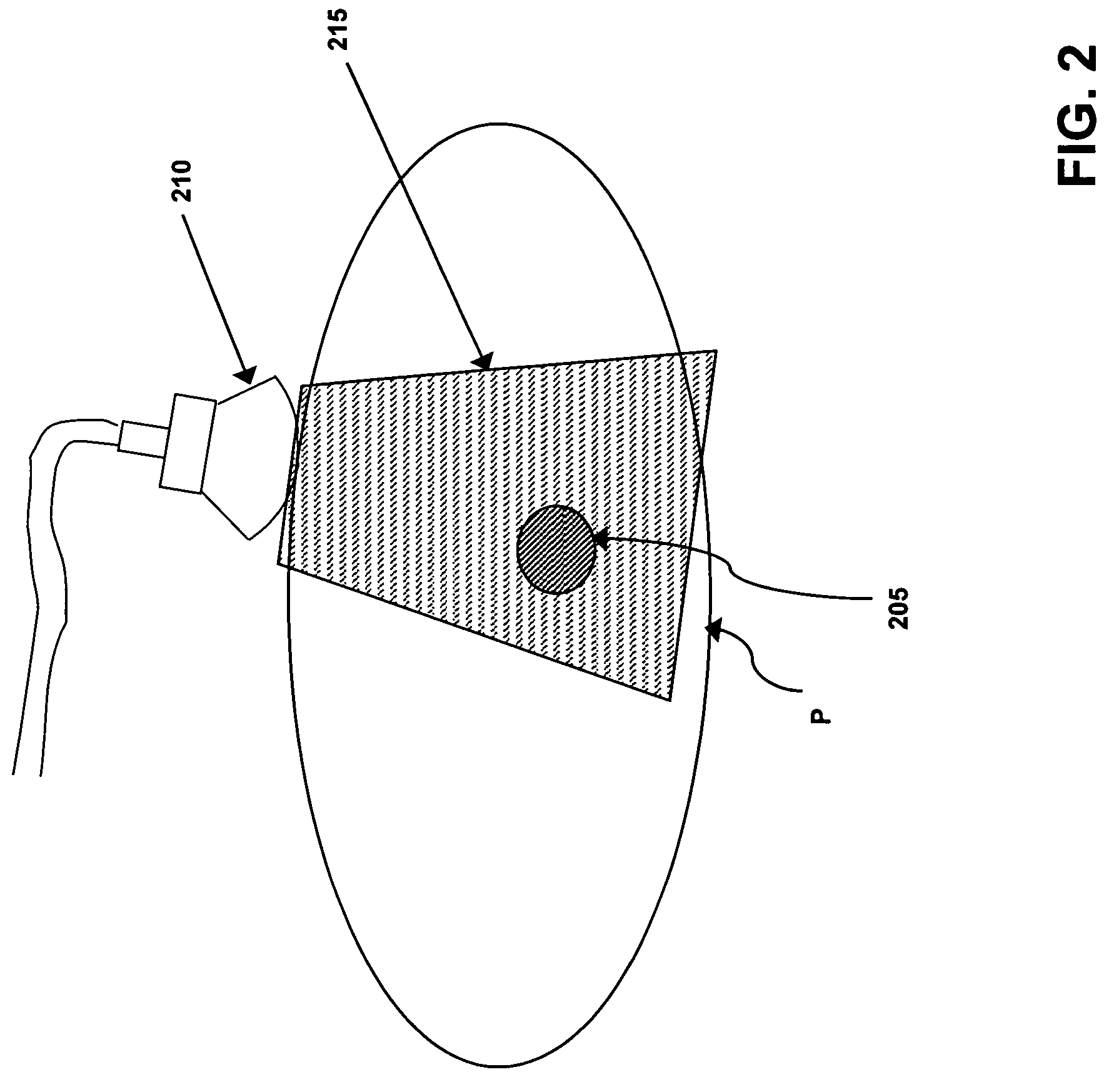 Radiotherapy treatment monitoring using ultrasound