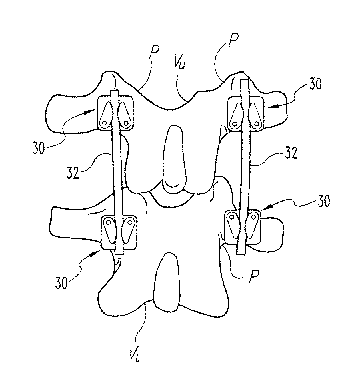 System and method for correcting spinal deformity