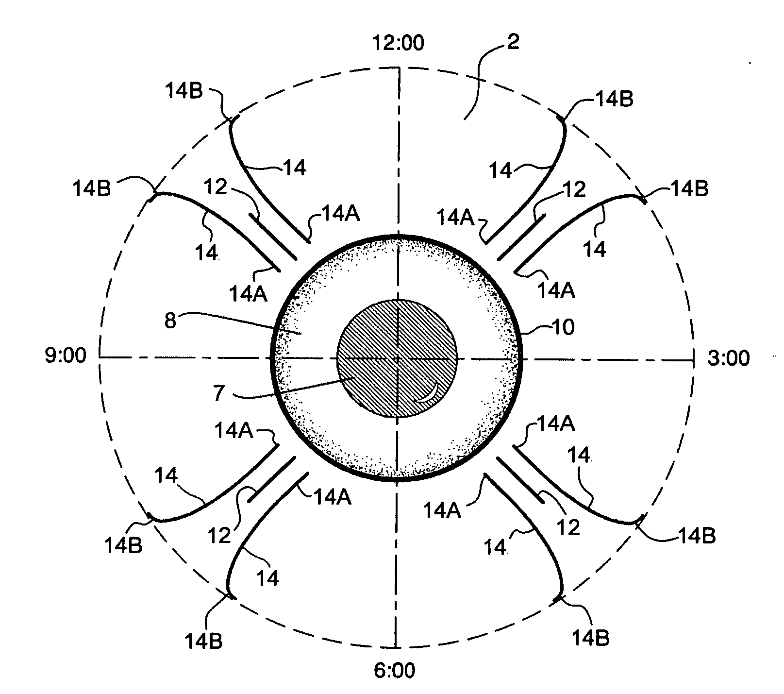 Method and system for radio frequency ophthalmological presbyopia surgery