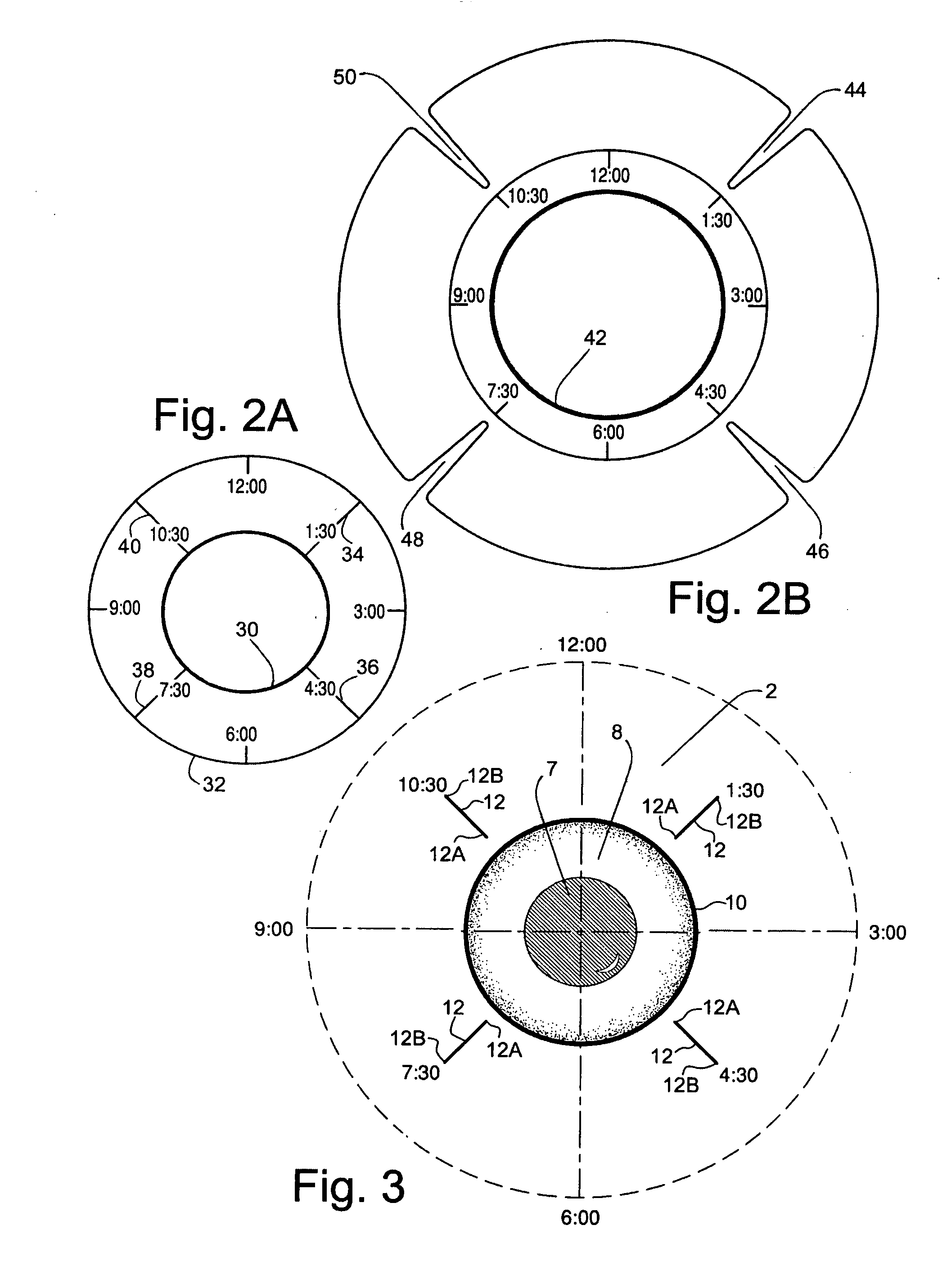 Method and system for radio frequency ophthalmological presbyopia surgery