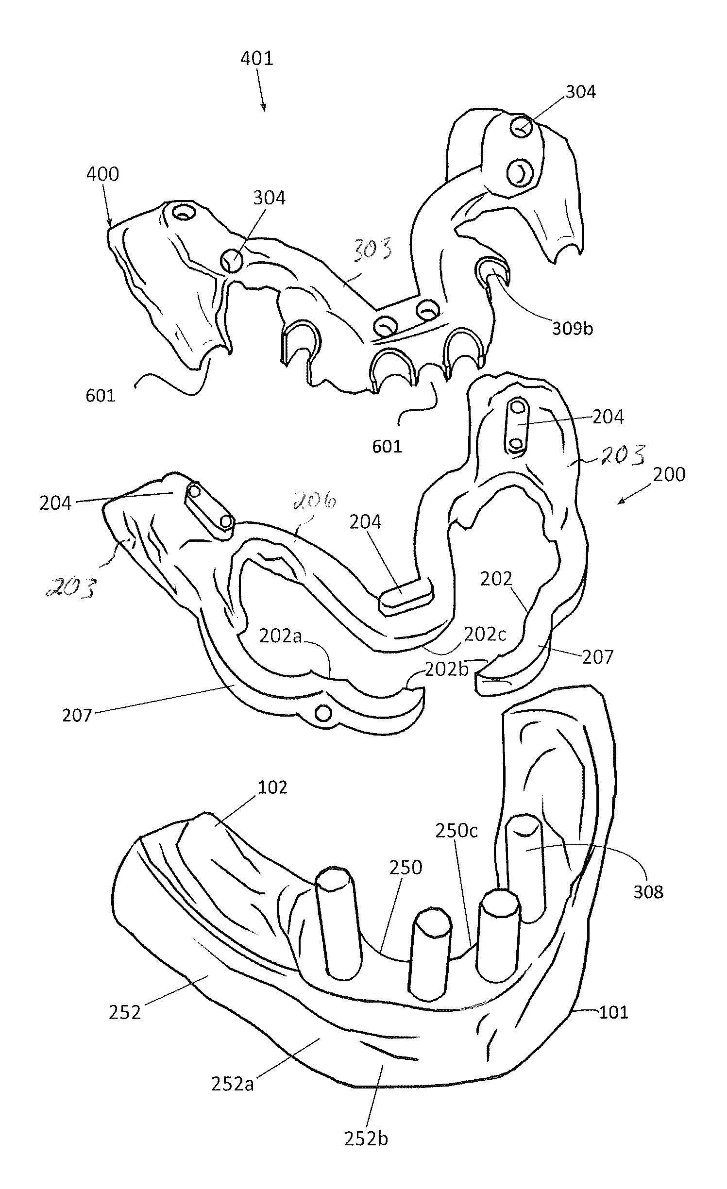 Edentulous surgical guide