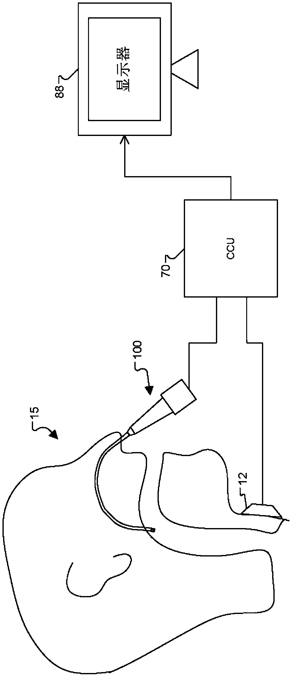 Improved vocal cord stroboscopy