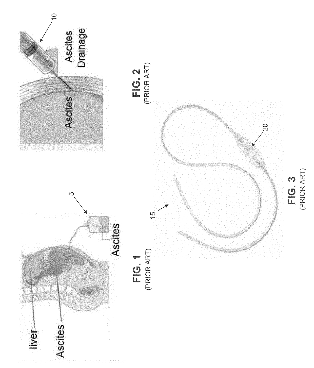 Method and apparatus for treating fluid build-up in a body cavity, including method and apparatus for treating ascites and pleural effusions