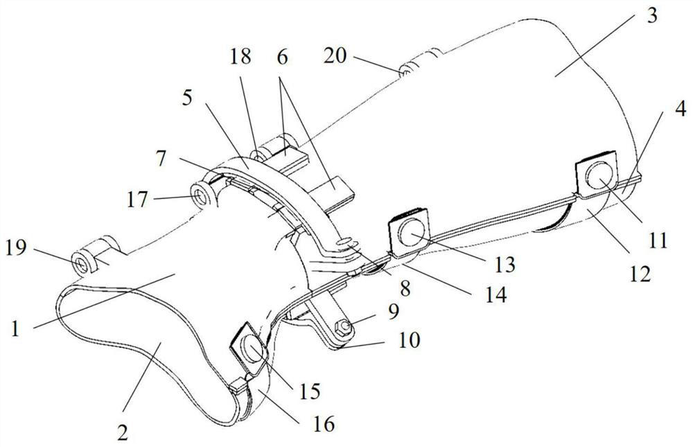Traction type personalized bone fracture medical splint and using method