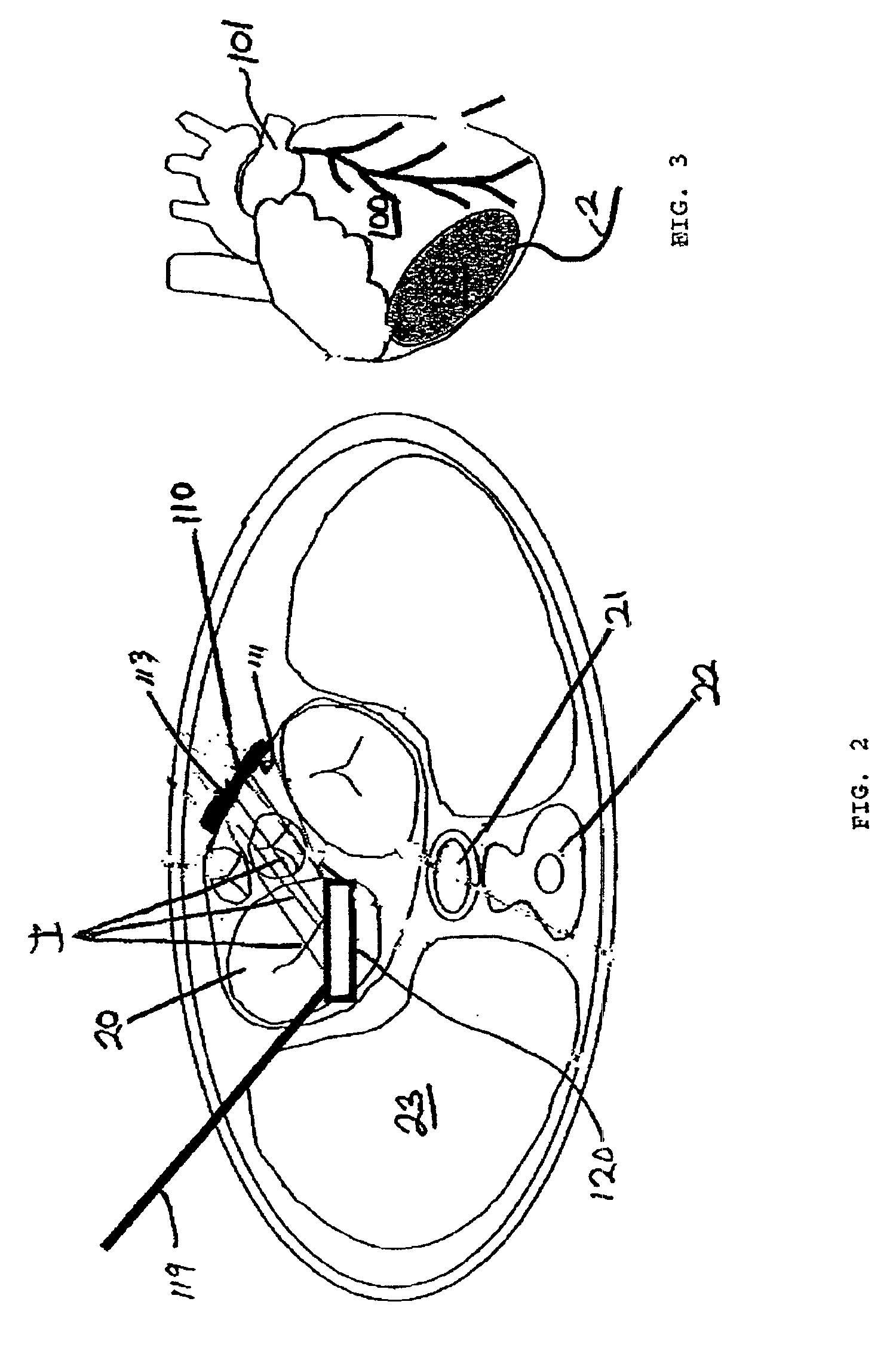 Expandable intracardiac return electrode and method of use