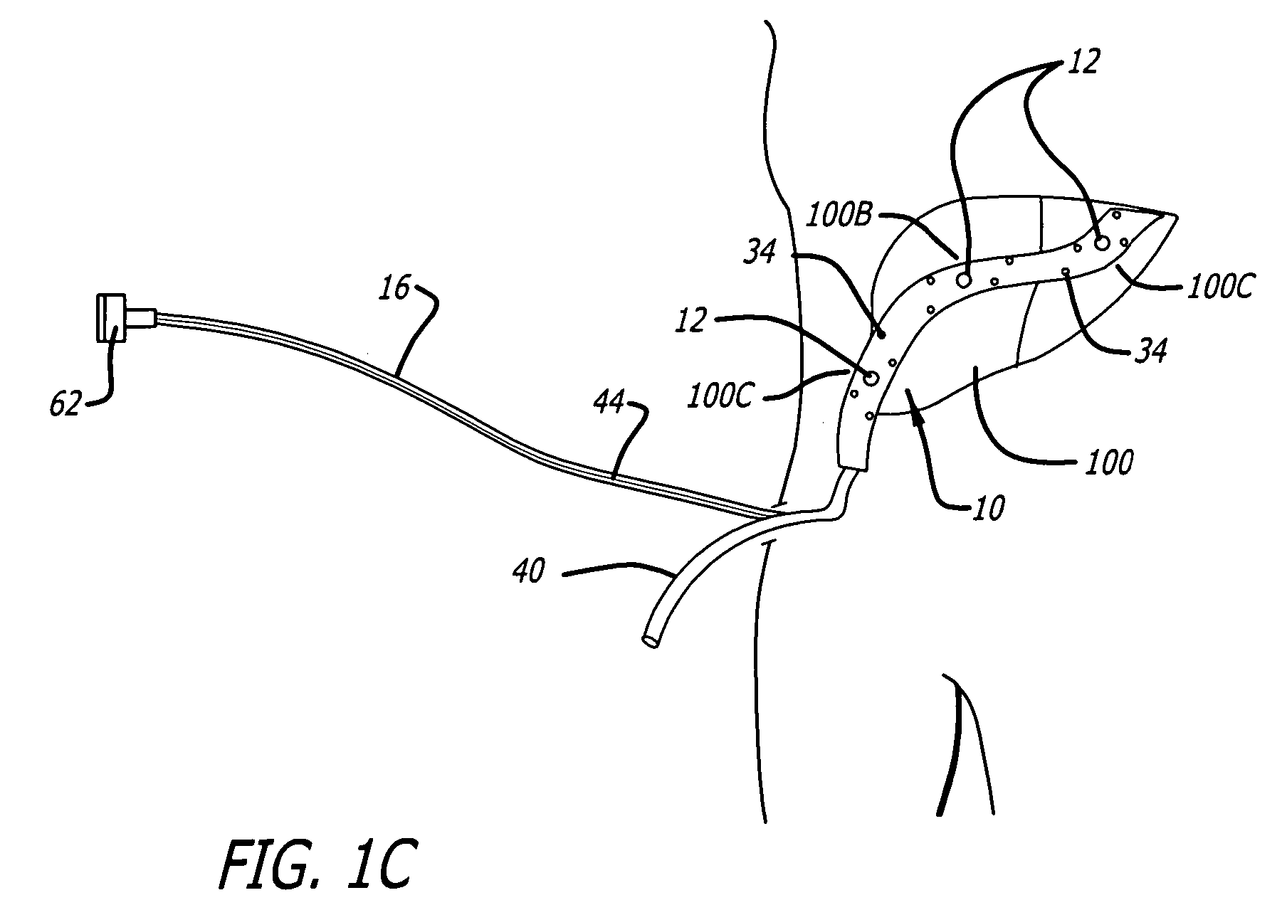 Surgical drain with sensors for differential monitoring of internal condition