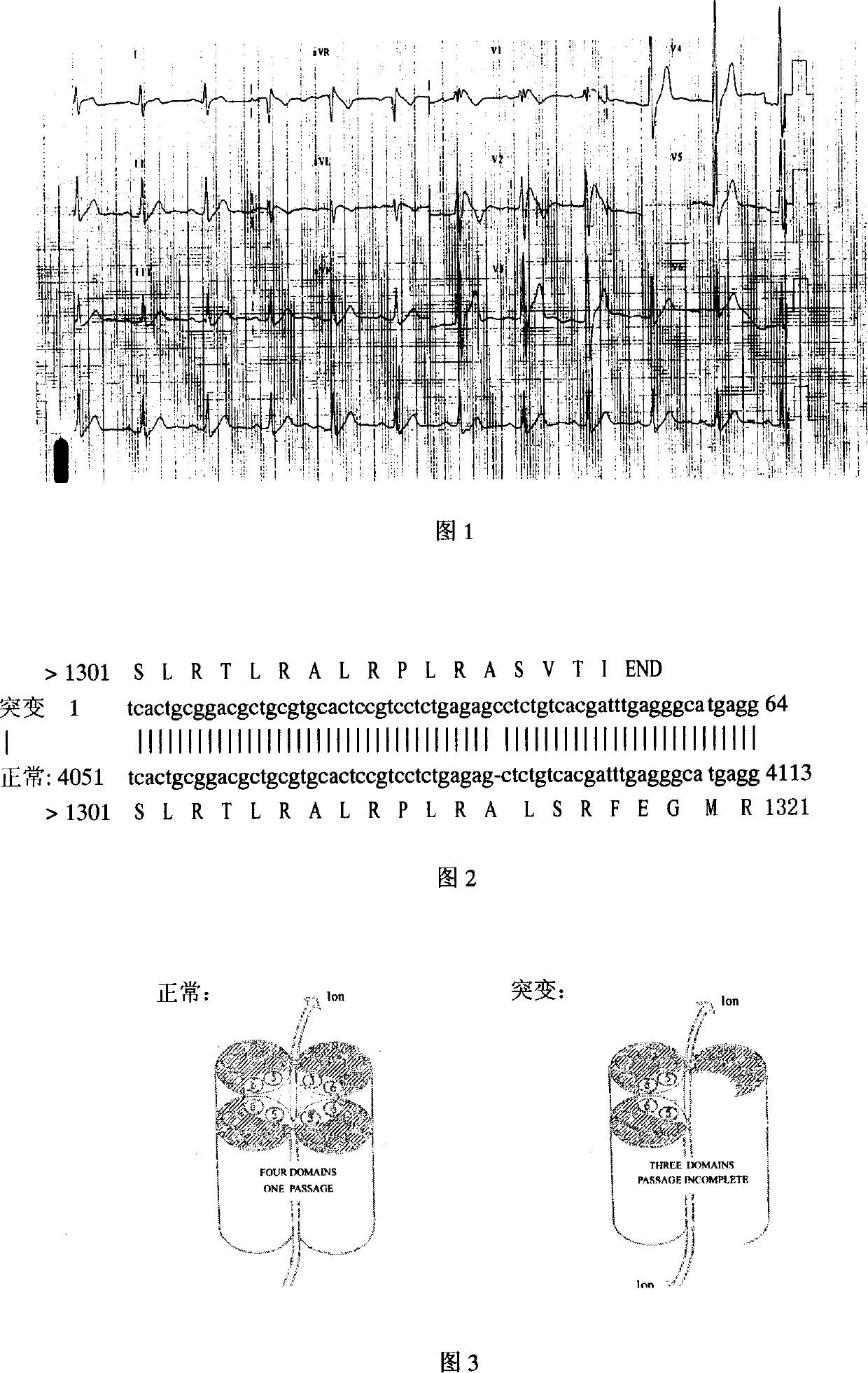 Method for inspecting gene mutantion of Brugada syndrome and its use