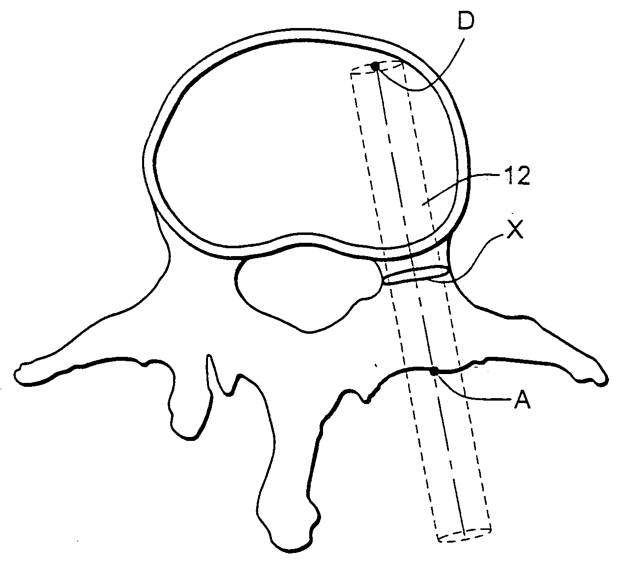 System and methods for improved access to vertebral bodies for kyphoplasty, vertebroplasty, vertebral body biopsy or screw placement
