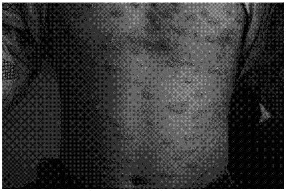 A kind of traditional Chinese medicine composition for treating children's psoriasis vulgaris