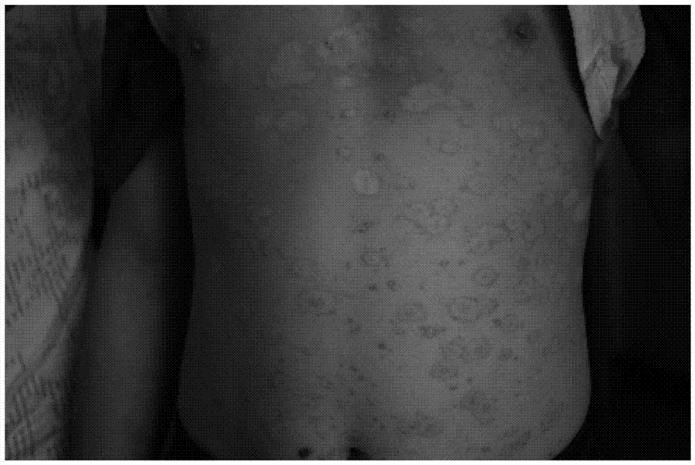 A kind of traditional Chinese medicine composition for treating children's psoriasis vulgaris