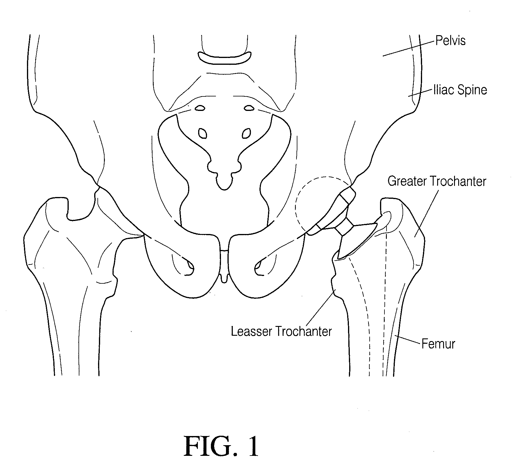 Hip surgery systems and methods