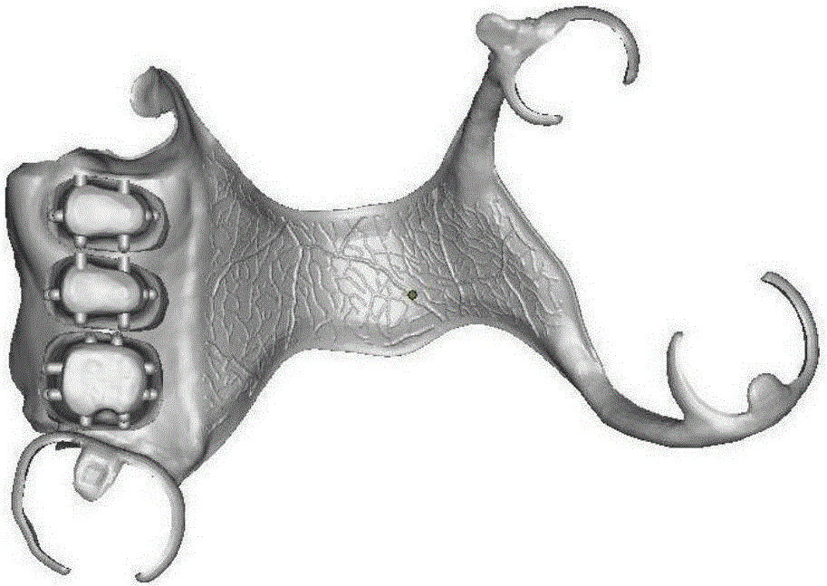 Dental restoration CAD (computer aided design)/metal 3D automatic processing method