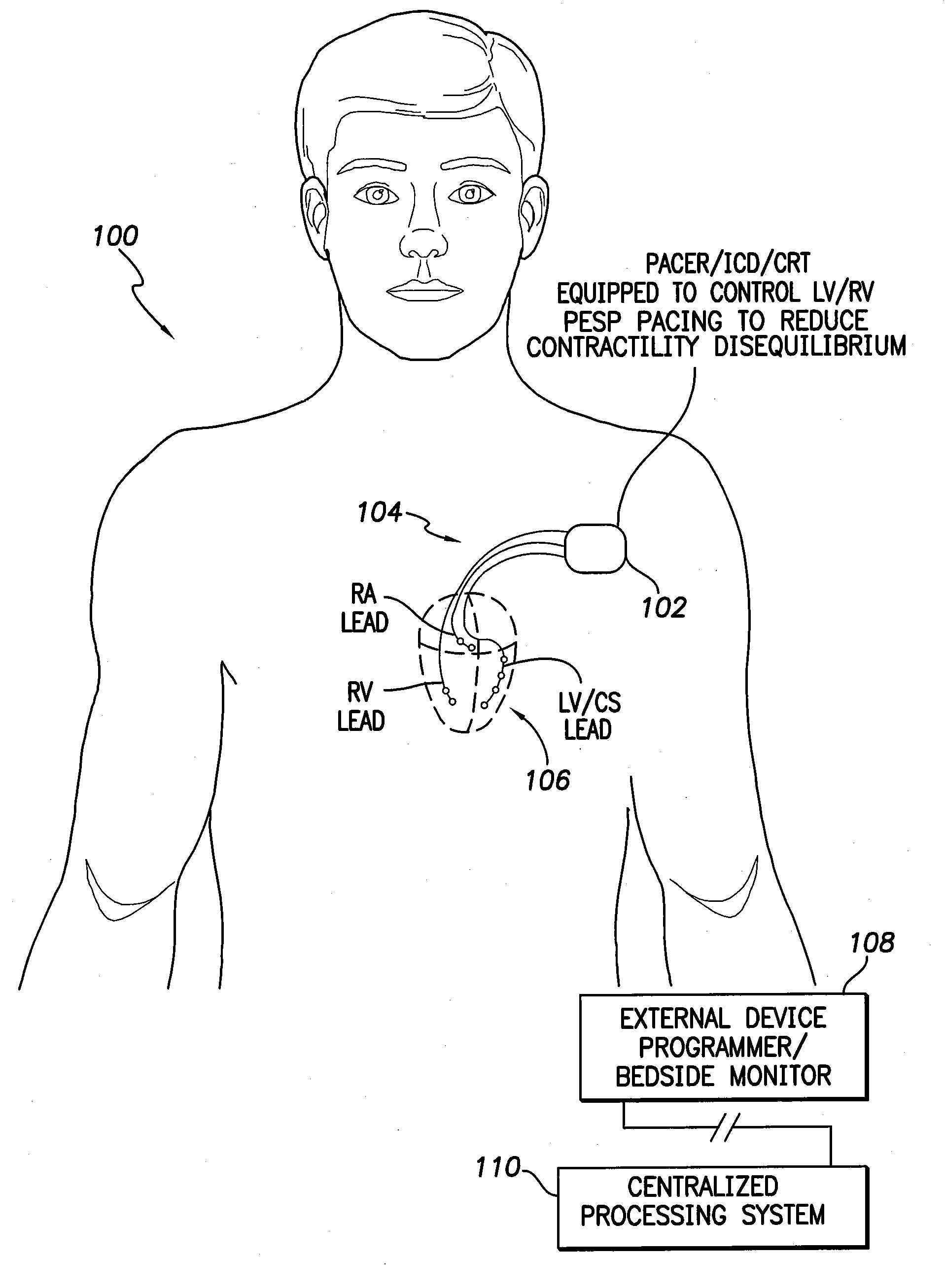 Systems and methods for controlling paired pacing interpulse intervals to reduce contractility disequilibrium using an implantable medical device