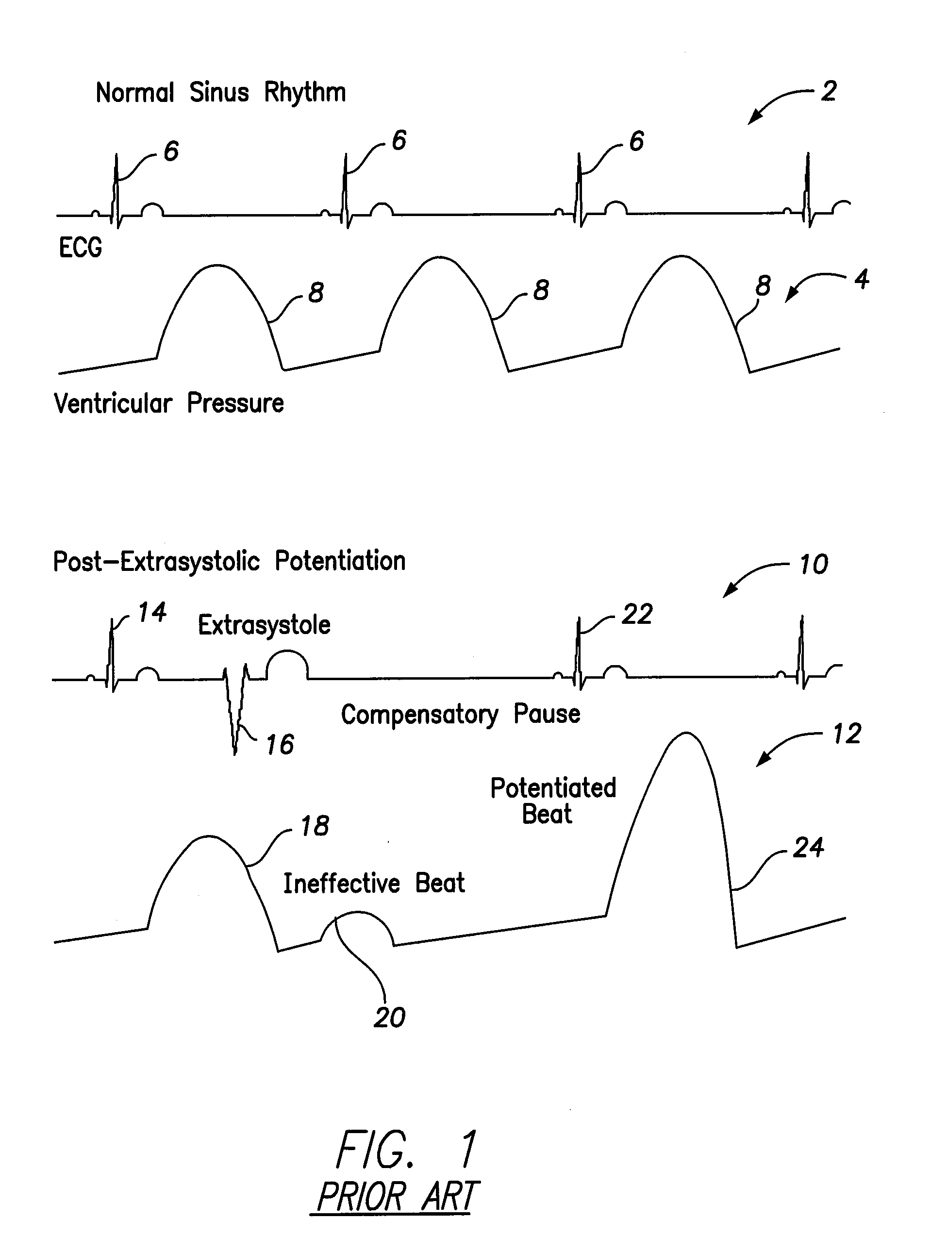 Systems and methods for controlling paired pacing interpulse intervals to reduce contractility disequilibrium using an implantable medical device