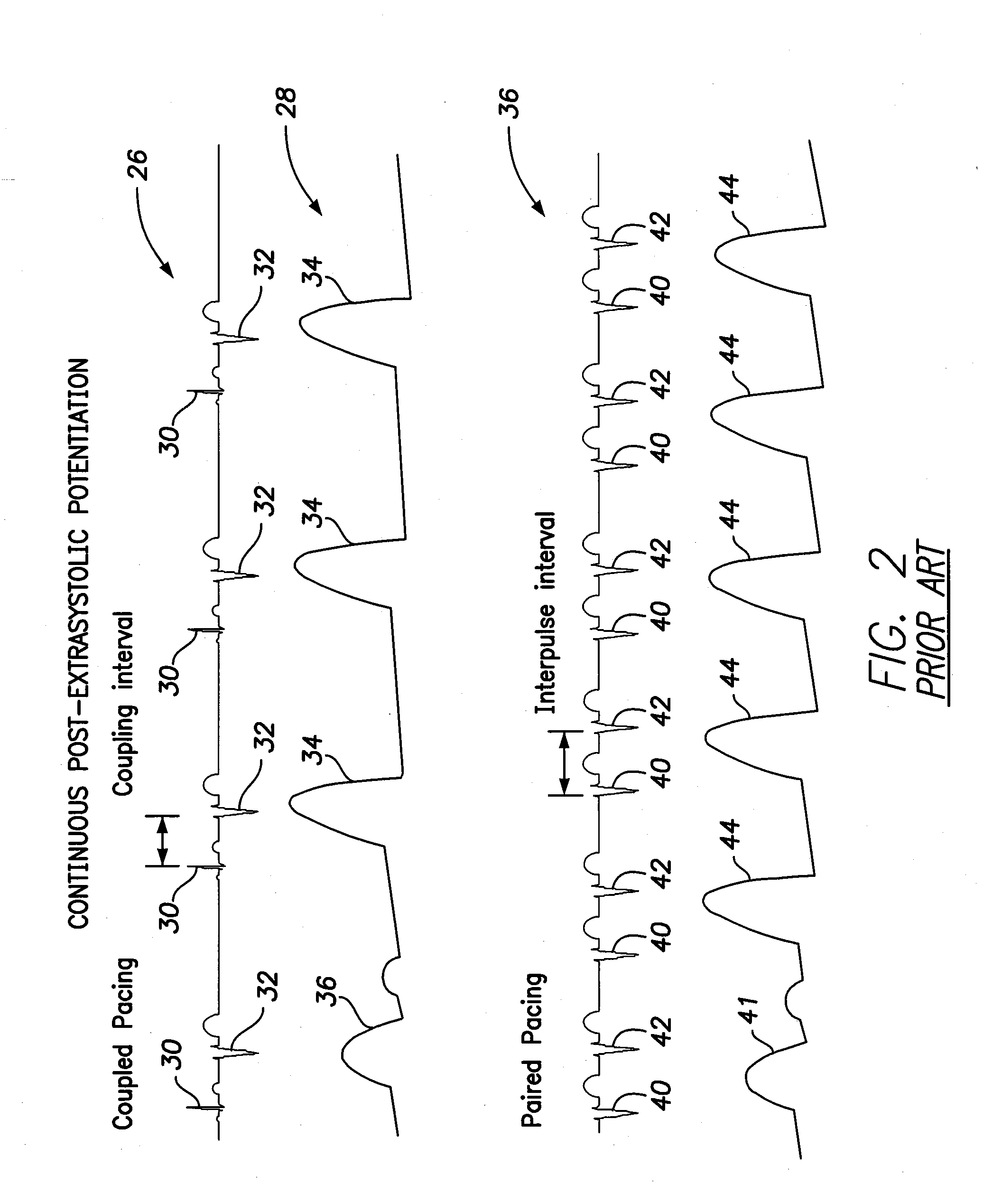 Systems and methods for controlling paired pacing interpulse intervals to reduce contractility disequilibrium using an implantable medical device