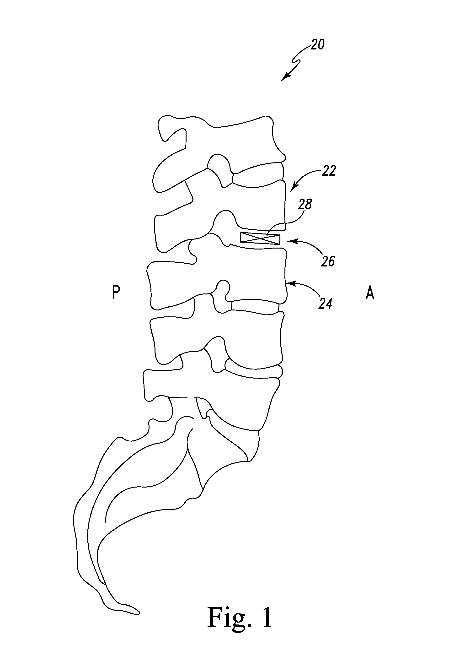 Expandable spinal devices and method of insertion