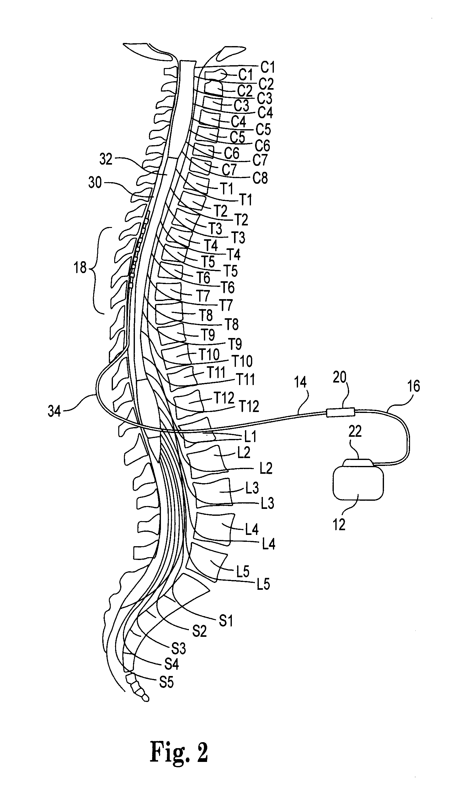 Epidural needle for spinal cord stimulation