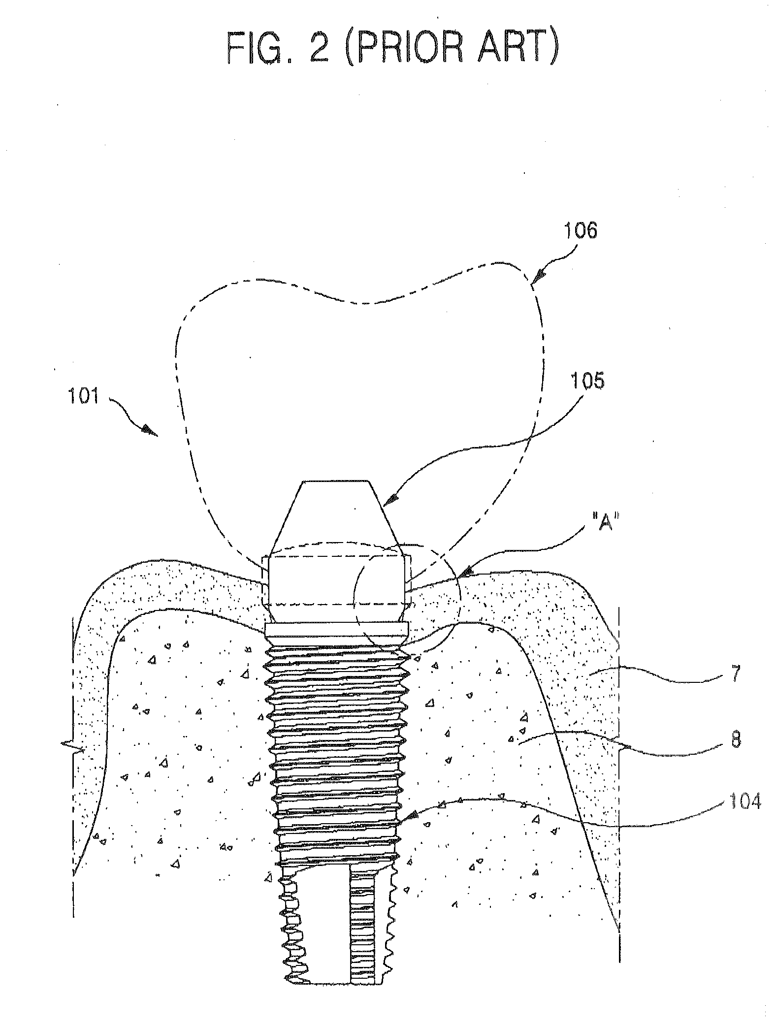 Healing Abutment and Dental Implant Having the Same